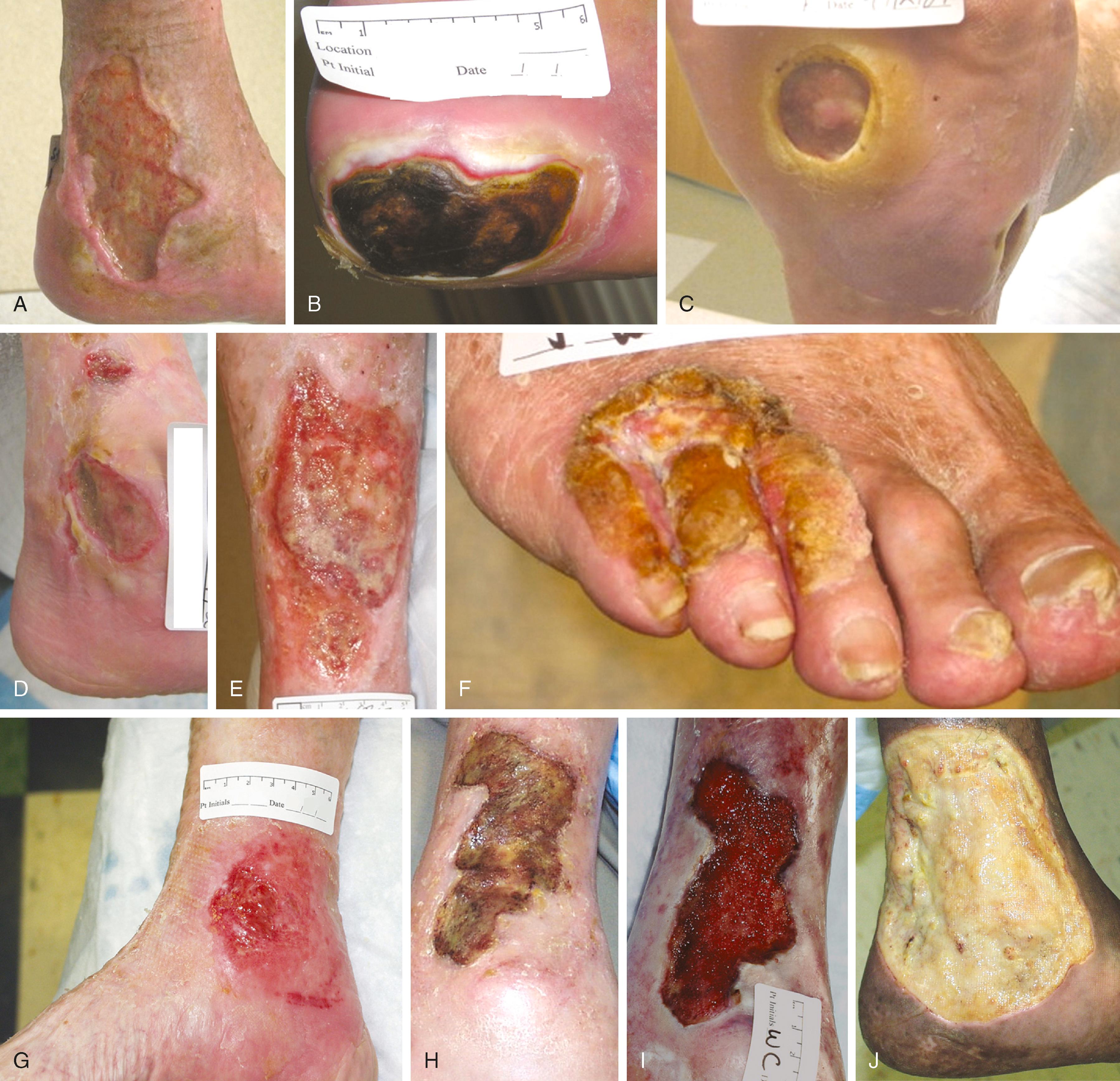 Figure 118.6, ( A ) Leg ulcer associated with chronic venous insufficiency. ( B ) Diabetic neuropathic ulcer. ( C ) Plantar ulcer in a patient with diabetes and chronic Charcot neuropathy. ( D ) Leg ulcer in a patient with both arterial and venous insufficiency. ( E ) Leg ulcer in a patient with systemic lupus and venous insufficiency. ( F ) Squamous cell carcinoma arising in a chronic foot ulcer. ( G ) Leg ulcer associated with rheumatoid arthritis. ( H ) Bacterial biofilm covering the surface of a nonhealing venous leg ulcer. ( I ) Same ulcer depicted in ( H ) after elimination of the biofilm following debridement and 2 weeks of antibiotic therapy. ( J ) Chronic leg ulcer in a patient with sickle cell anemia.