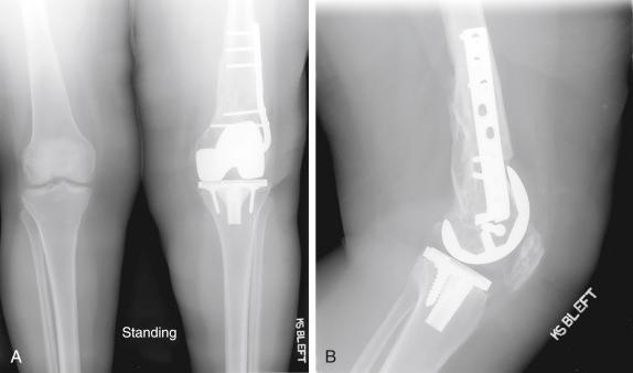 FIGURE 36.2, Anteroposterior ( A ) and lateral ( B ) radiographs of the left knee demonstrate a cemented cruciate-retaining total knee arthroplasty with medial polyethylene wear and evidence of prior internal fixation of a supracondylar distal femur fracture with a blade plate.