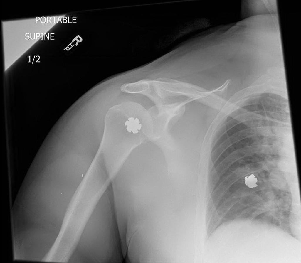 FIGURE 1, Radiograph showing two - mm jacketed hollow bullets that have opened up on tissue impact. Note the star-shaped pattern of the bullets that are overlying the proximal humerus and right chest wall.