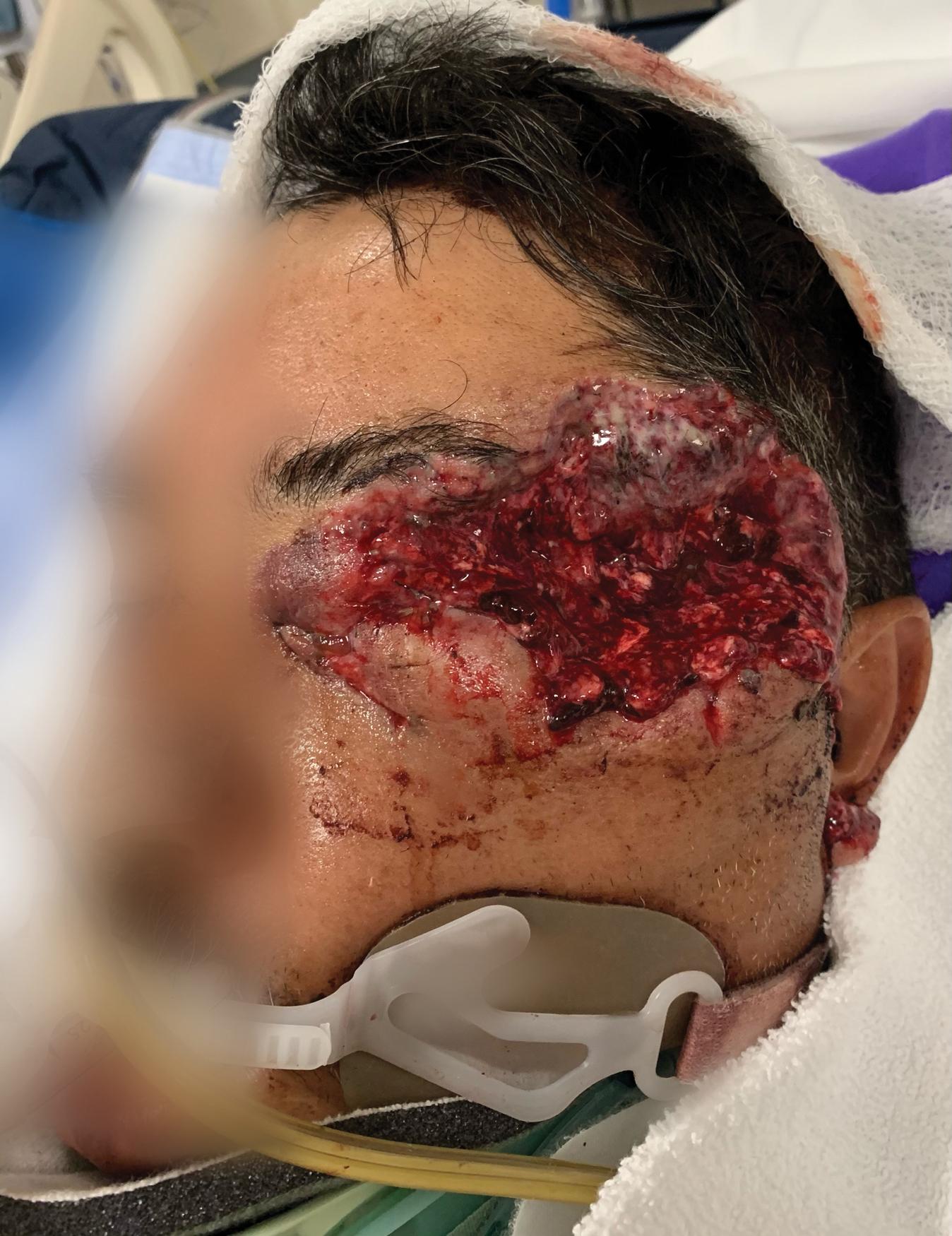 FIGURE 3, Close-range negligent discharge of a 30-06 rifle round resulting in a tangential wound to the face and complete destruction of the left globe.