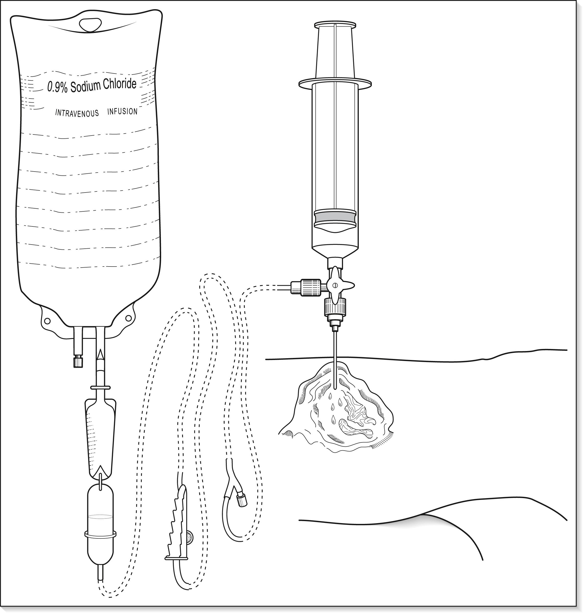 FIG. 3.10.1, Wound irrigation set-up comprising flask of fluid, intravenous tubing, three-way tap, syringe and 19-gauge needle designed to deliver fluid at a pressure of at least 8 psi (55 kPa).