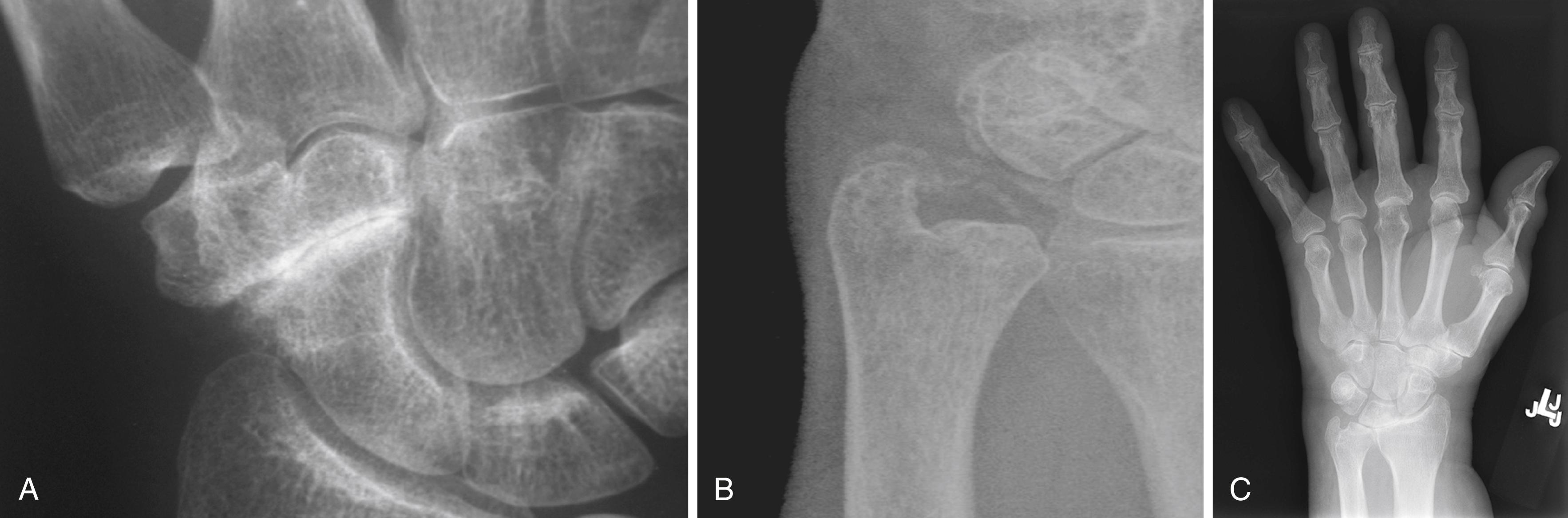 Fig. 12.1, A, Scaphotrapeziotrapezoidal arthrosis may be just localized to one hand, although the majority of patients suffer from bilateral disease. B, The association with calcium pyrophosphate deposition disease (CPDD) is obvious in this patient with calcific changes in the triangular fibrocartilage complex. C, Figure demonstrates a PA view of a patient with known CPPD and obvious joint space narrowing at the radiolunate joint.
