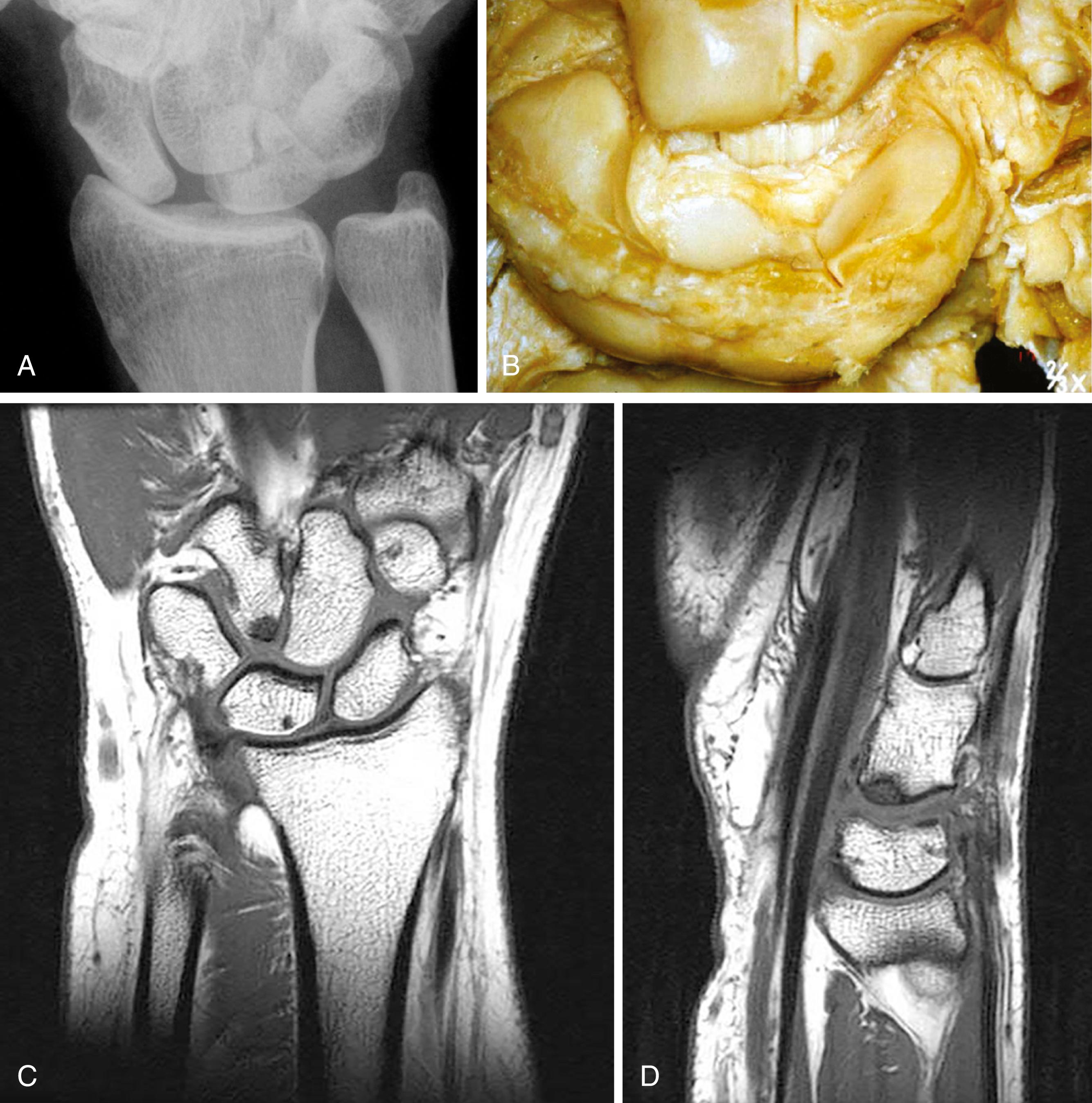 Fig. 12.2, A, This radiograph of a wrist under axial load clearly demonstrates scapholunate dissociation but is also suggestive of hamolunate impingement. B, This cadaveric specimen demonstrates hamolunate impaction, which can occur and may compromise radiolunate and radioscapholunate arthrodesis. C and D, The most appropriate investigation is magnetic resonance imaging, which shows significant bone edema at the tip of the hamate.