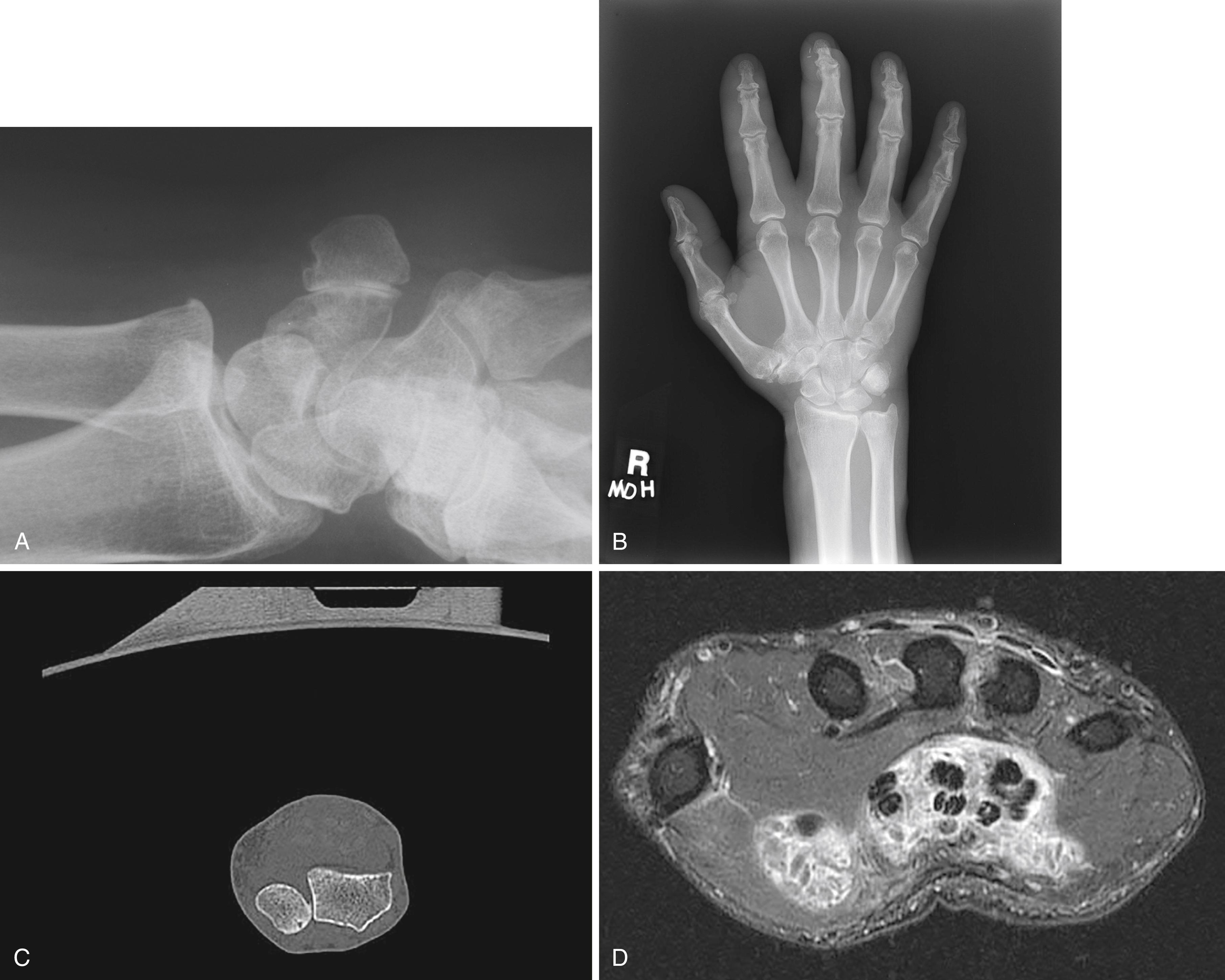 Fig. 12.3, A, If not recognized preoperatively, pisotriquetral arthrosis can be painful, irritate the ulnar nerve in the canal of Guyon, and detract from an otherwise successful surgical wrist procedure. B, A PA radiograph of a patient with pain at the distal radioulnar joint and radiographic suspicion of arthritis is shown. C, An axial CT scan of the same patient illustrates more clearly the arthritic process demonstrating joint space narrowing—note also the subchondral cysts and volar osteophyte of the ulnar head. D, An axial T2-weighted image of a patient with inflammatory arthritis. Note the extensive flexor tendon tenosynovitis.