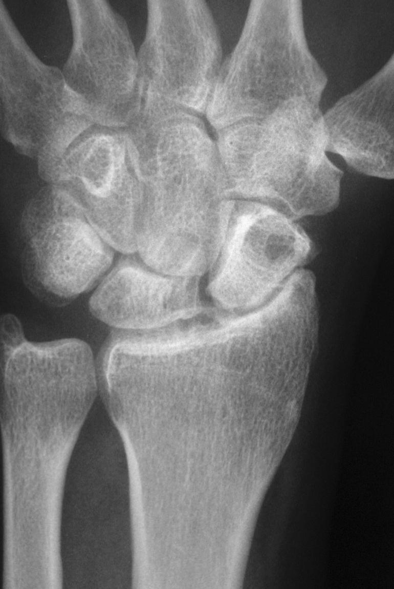 Fig. 12.4, Scapholunate advanced collapse pattern of arthrosis of the wrist. Localized arthrosis of the scaphoid fossa begins at the styloid tip (stage I), proceeds to the proximal scaphoid fossa (stage II), and is followed by capitolunate arthrosis (stage III). The lunate may fall into dorsiflexion (dorsal intercalated segment instability [DISI]) and the scaphoid into flexion as seen here, but the integrity of the radiolunate articulation is preserved until late in the process.