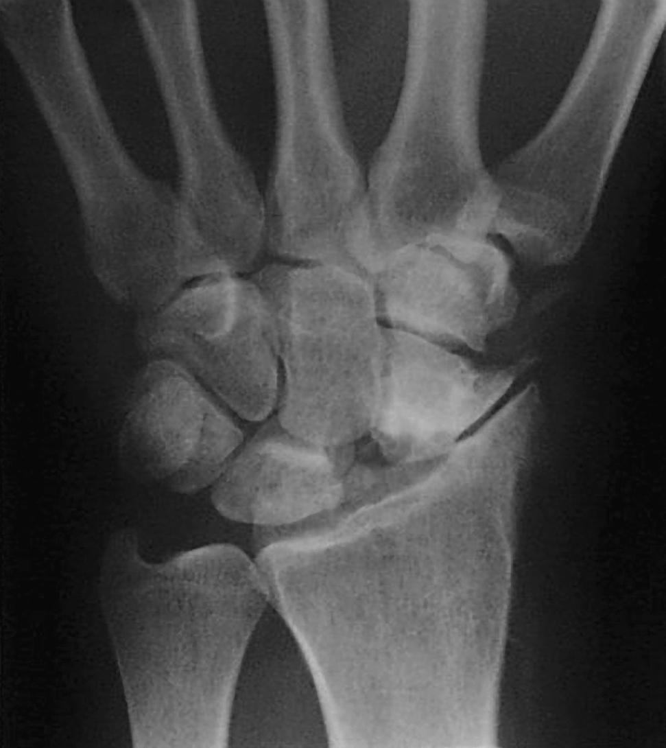 Fig. 12.5, Scaphoid nonunion advanced collapse (SNAC) pattern of arthrosis of the wrist. Degenerative changes develop in the distal segment of the scaphoid (stage I), and the proximal segment is spared. 56 As in this case, excision of the proximal pole of the nonunited scaphoid will precipitate a combination of instability and SNAC. The scaphocapitate joint deteriorates in stage II.