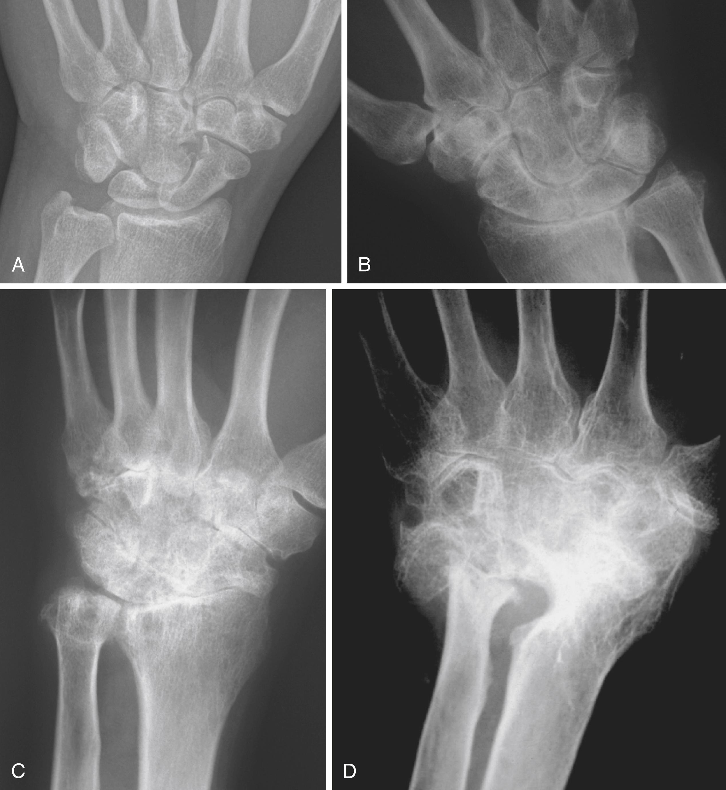 Fig. 12.6, A, The conservative wrist. Integrity of the ligament and joint surfaces characterizes this phase of the disease, although erosions may be seen. B, The restorative wrist. The secondary arthrosis is principally confined to the lunate fossa and suggests that radiolunate fusion is an appropriate option. In this radiograph, the presence of translocation and radioscaphoid arthritis indicates that radioscapholunate fusion is the preferred option. C, The reconstructive wrist. Bony stock is well preserved, although all joints are significantly affected, thus giving the opportunity to consider wrist replacement as an option. D, The salvage wrist. Very poor bone stock remains, and with marked bone loss, arthrodesis remains the most likely choice, although each case must be taken on its merits.