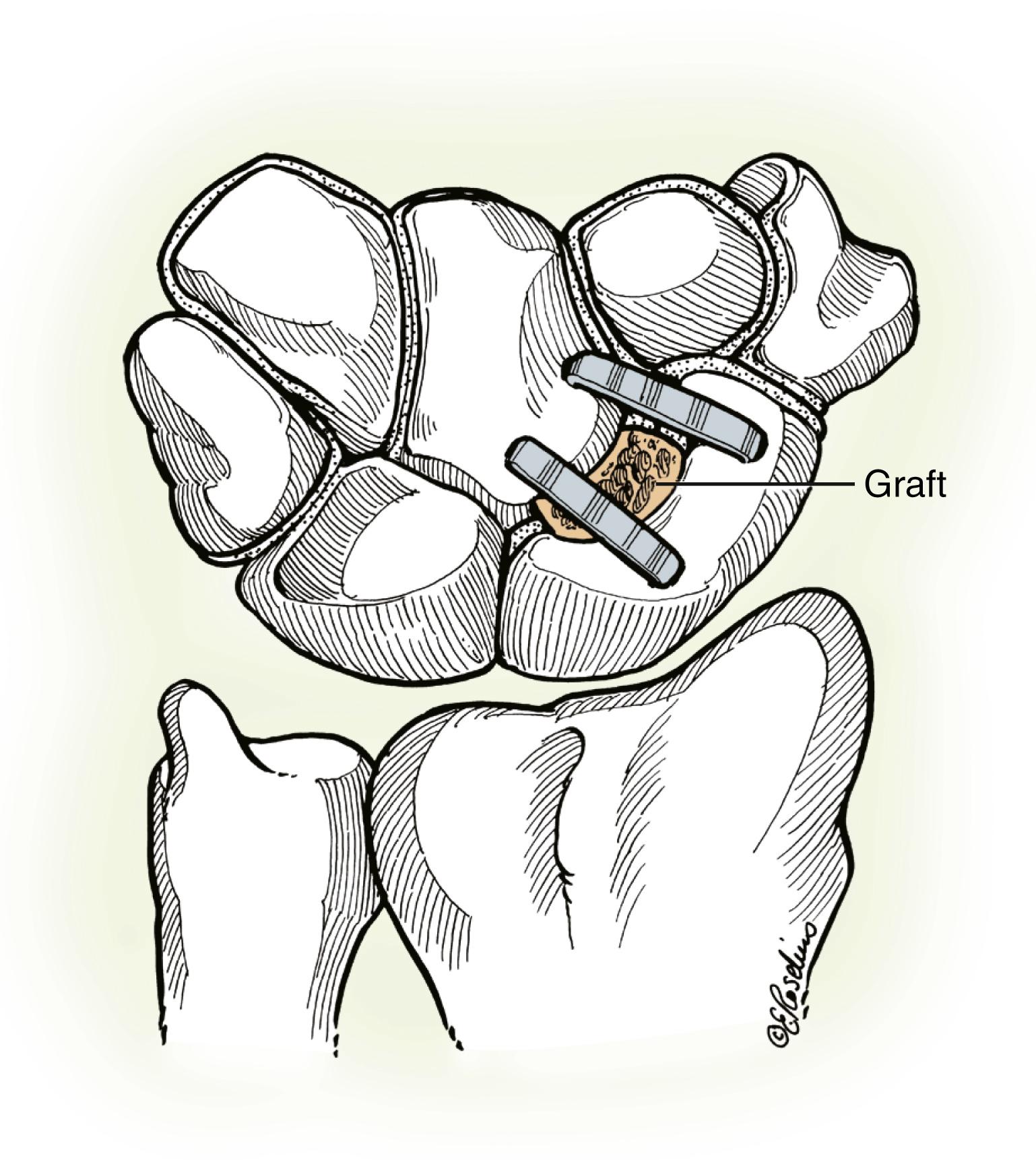 Fig. 12.7, Scaphocapitate fusion with staples. Normal space between the scaphoid and capitate is maintained by preserving the volar 25% articulation of both bones.