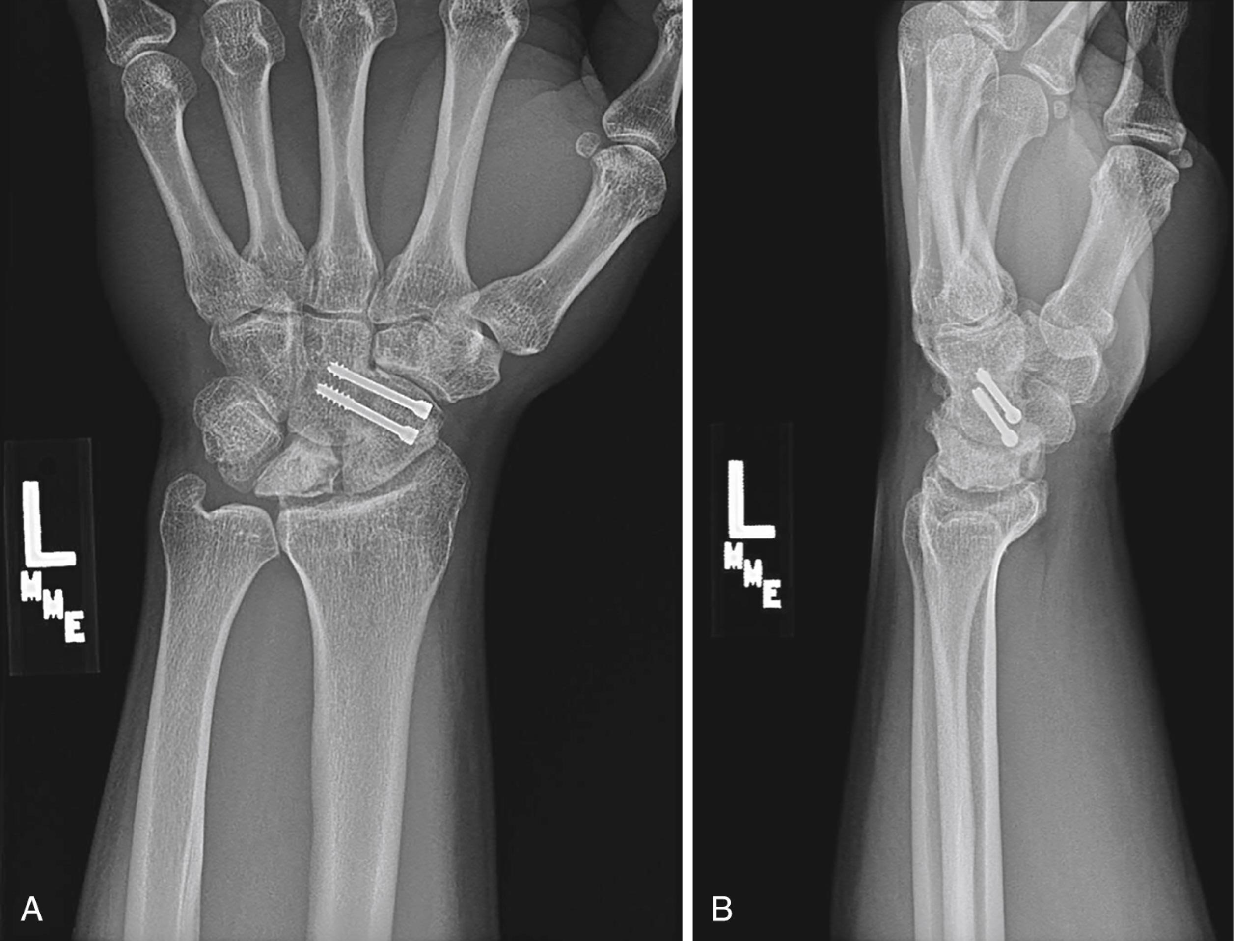 Fig. 12.8, Figure shows PA (A) and lateral (B) views of a patient’s status 5 years post-scaphocapitate fusion utilizing headless compression screws for the treatment of Kienböck disease.