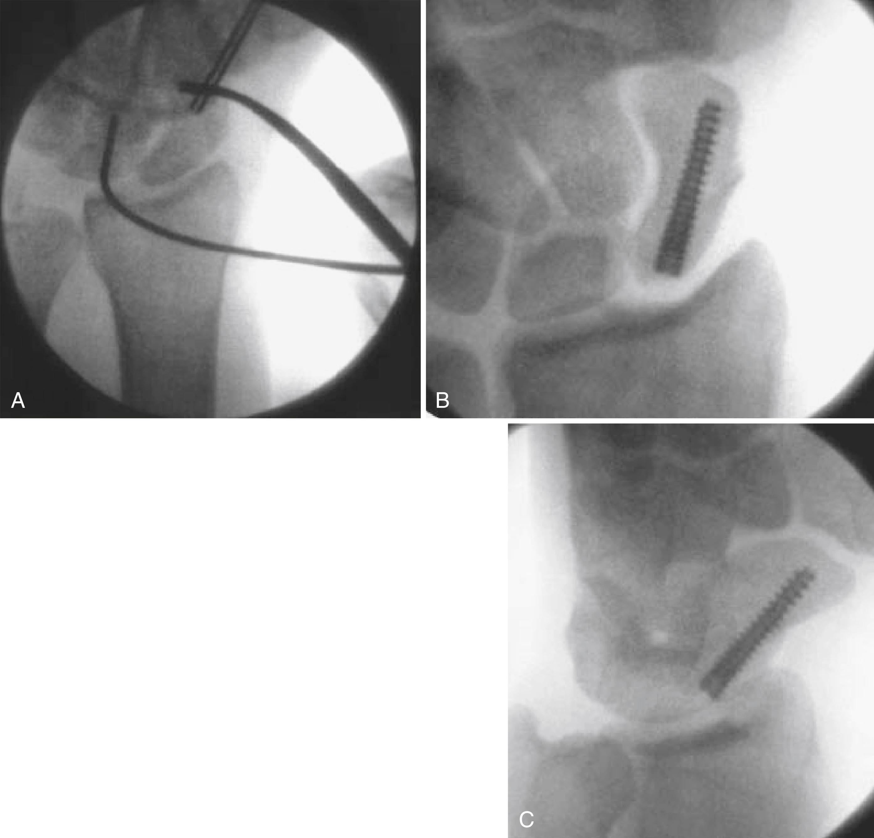 FIGURE 69.32, Percutaneous fixation of scaphoid fracture. A, Joysticks and antiglide wires are maintained during drilling and dorsal implantation of screw. B and C, Fluoroscopy confirms placement of headless compression screw. (From Slade JF III, Gutow AP, Geissler WB: Percutaneous internal fixation of scaphoid fractures via an arthroscopically assisted dorsal approach, J Bone Joint Surg 84A[Suppl 2]:21, 2002.) SEE TECHNIQUE 69.8 .
