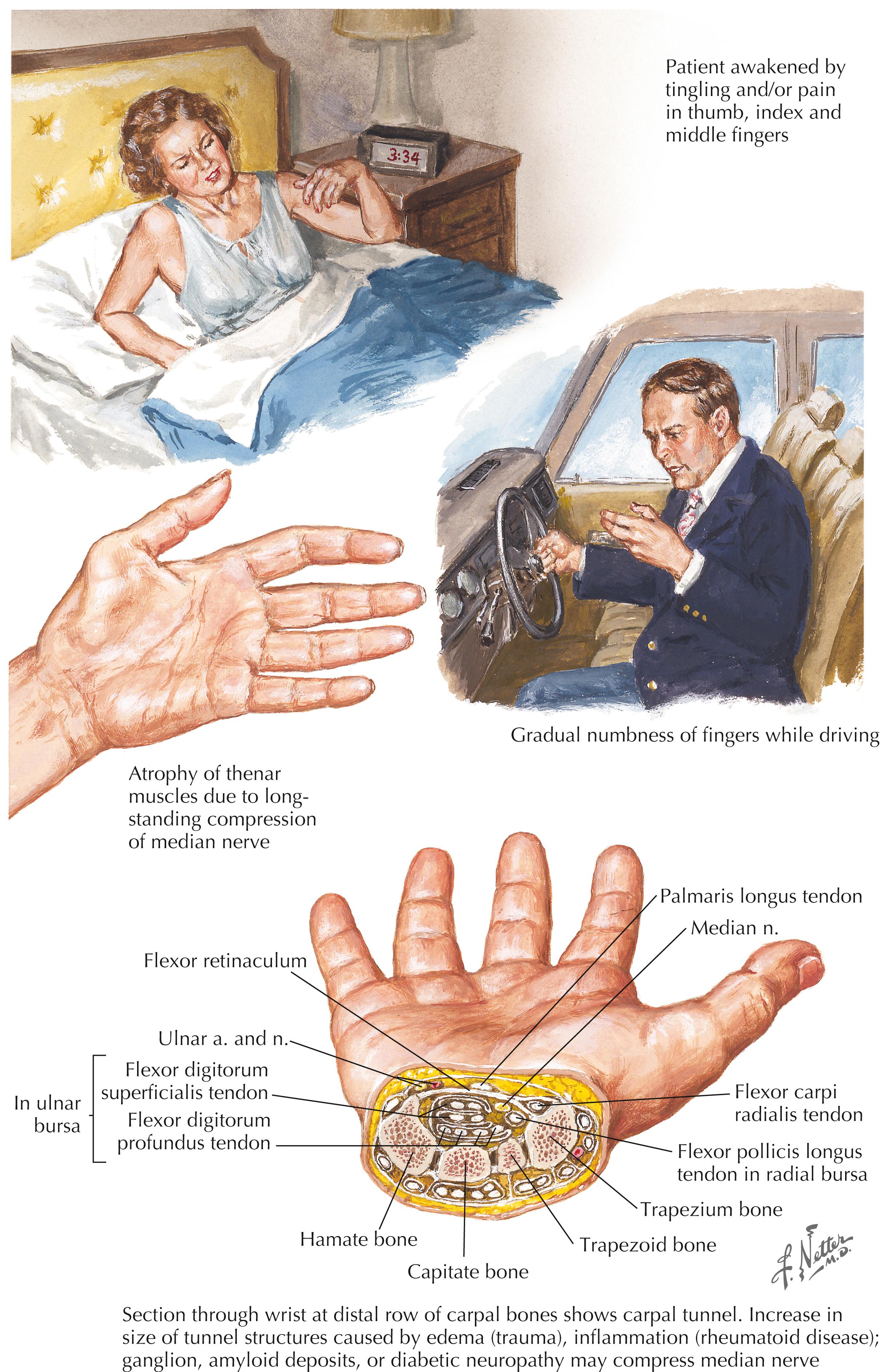 Figure 11-14, Carpal tunnel syndrome.