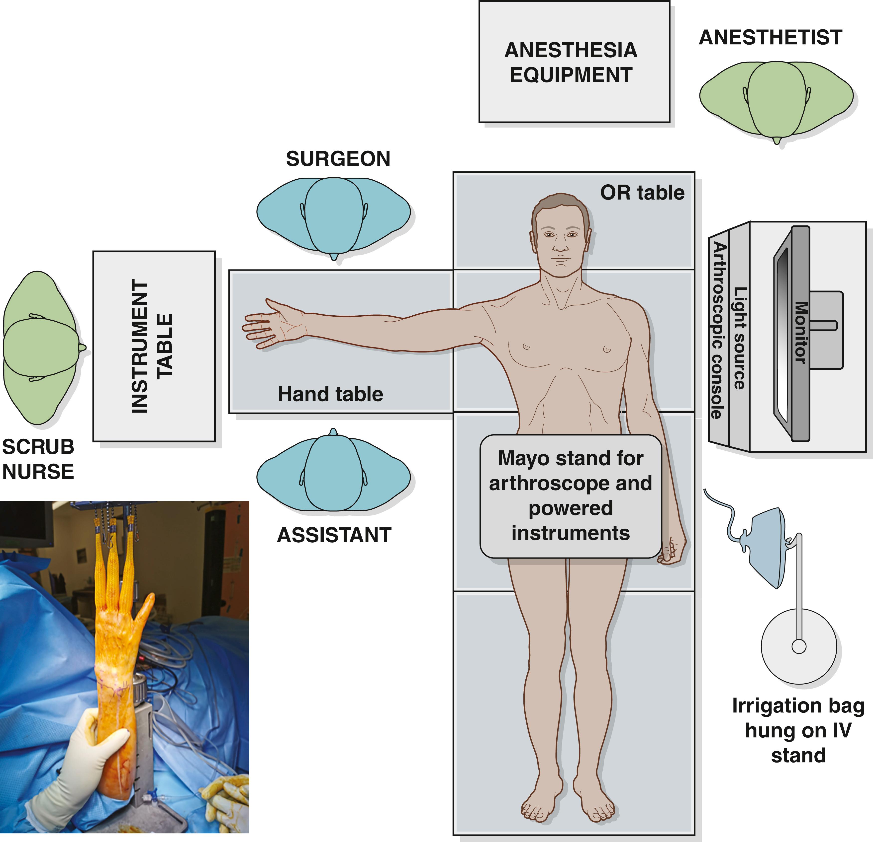 Fig. 17.1, Standard wrist arthroscopy setup, patient and surgeon position in operating room.