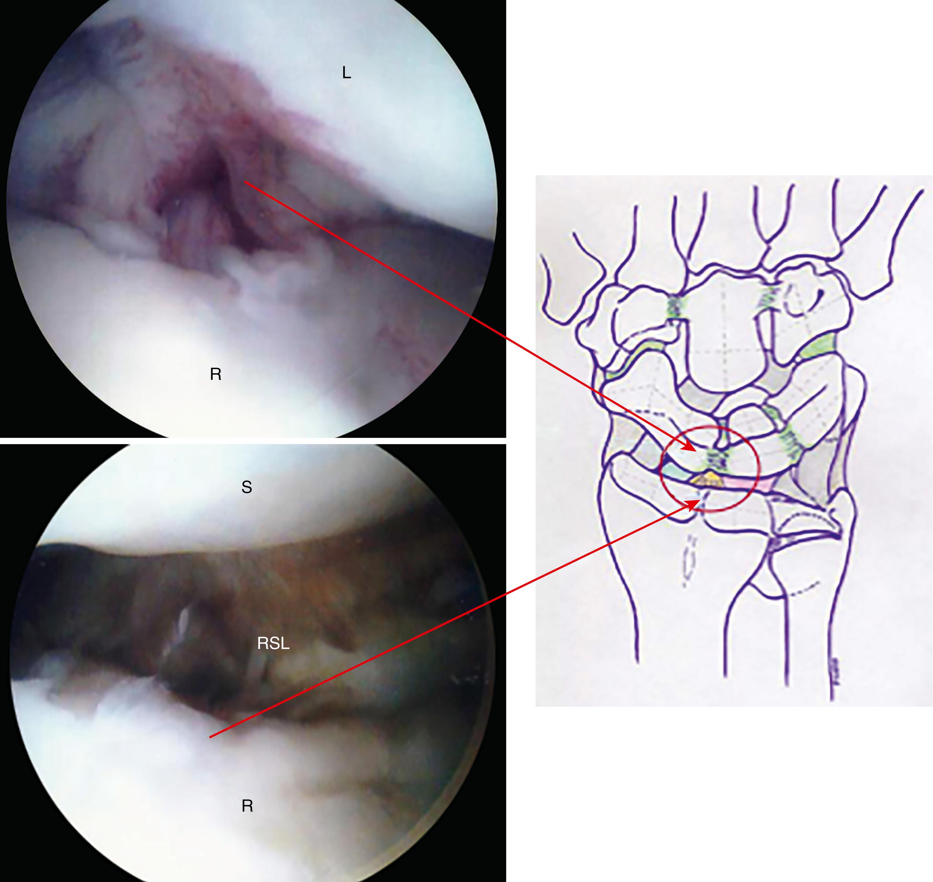 eFig. 17.11, Ligament of Testut as viewed from 3-4 portal. L, Lunate; R, Radius; RSL, radioscapholunate ligament; S, scaphoid.