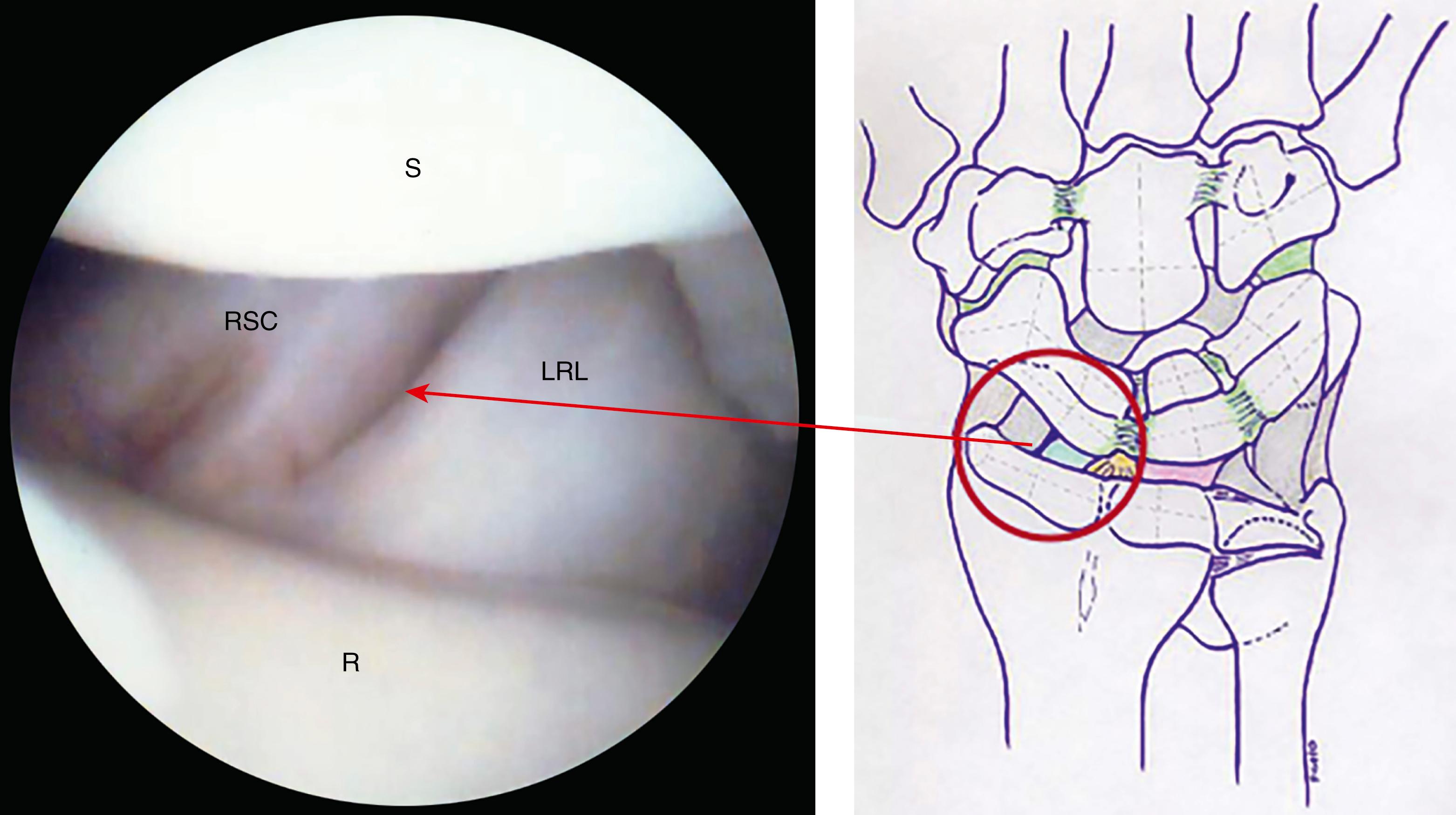 eFig. 17.12, Radioscaphocapitate and long radiolunate ligaments. Note the normal sulcus between the ligaments. LRL, Long radiolunate ligament; R, radius; RSC, radioscaphocapitate ligament; S, scaphoid.