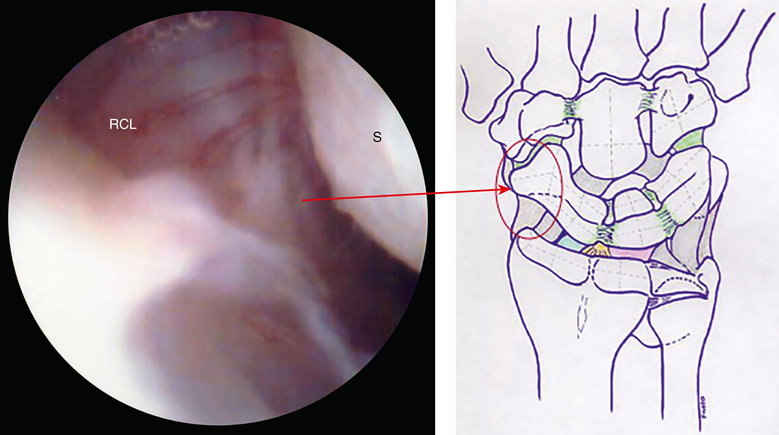 eFig. 17.13, Capsular reflection on scaphoid. RCL, Radial collateral ligament; S, scaphoid.