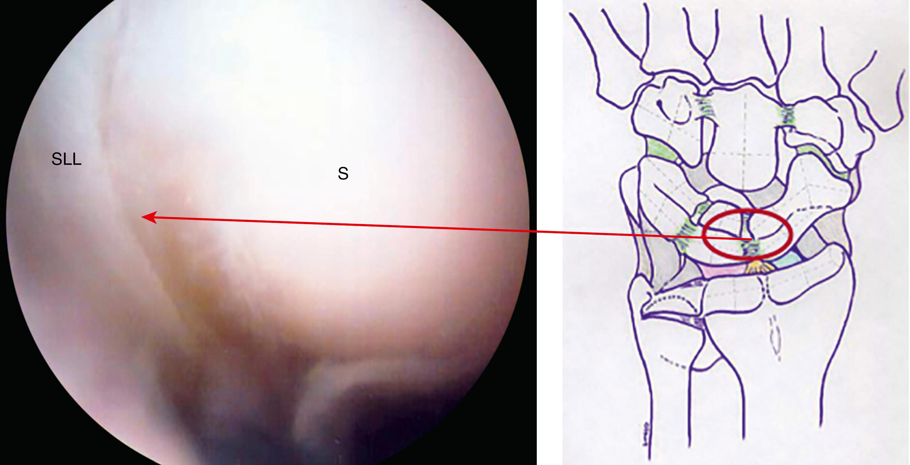 eFig. 17.15, Dorsal portion of SL ligament. S, Scaphoid; SLL, scapholunate ligament.