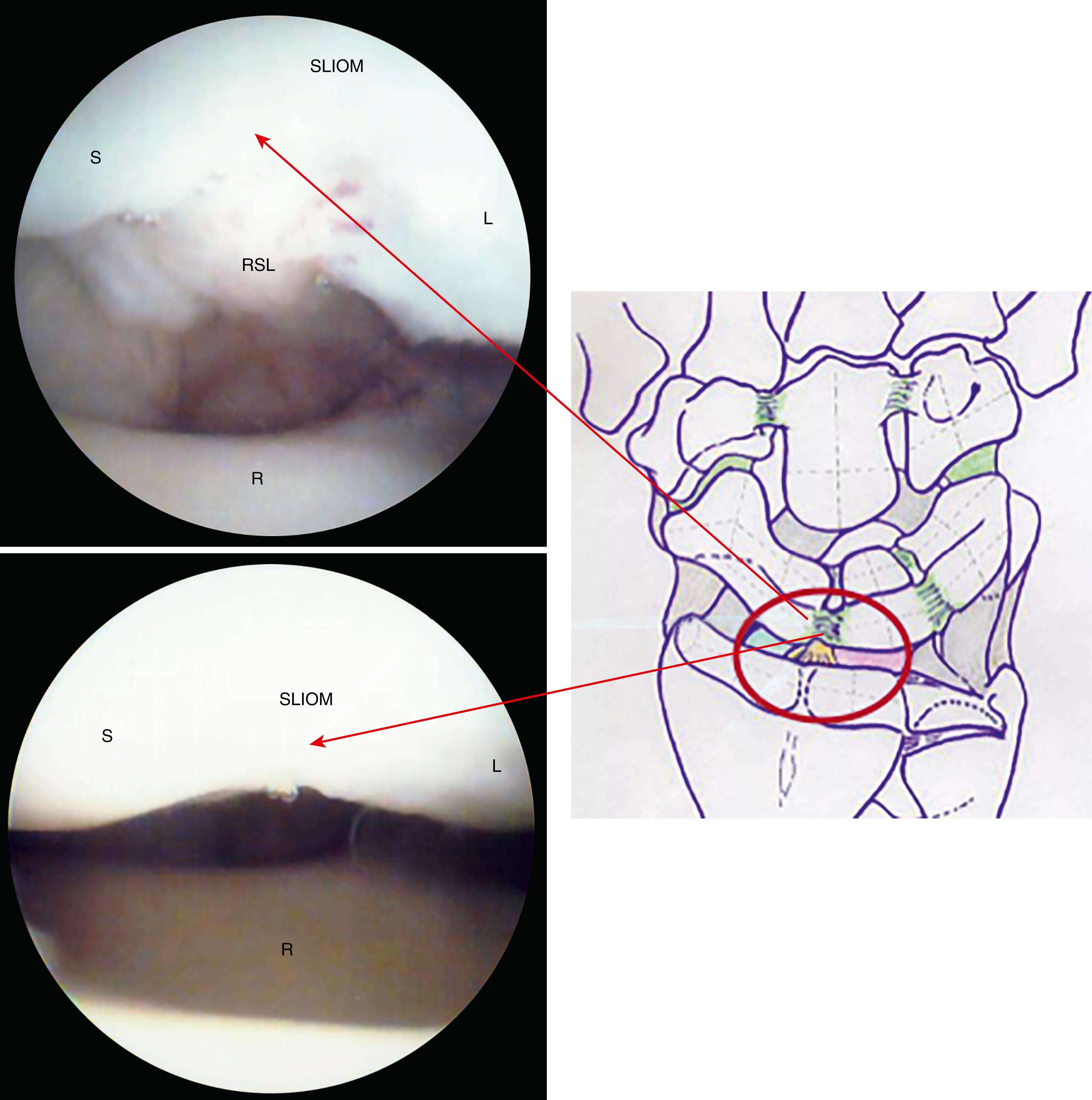 eFig. 17.16, Scapholunate interosseous membrane (SLIOM), which is the proximal part of the SL ligament. L, Lunate; R, radius; RSL, radioscapholunate ligament; S, scaphoid.