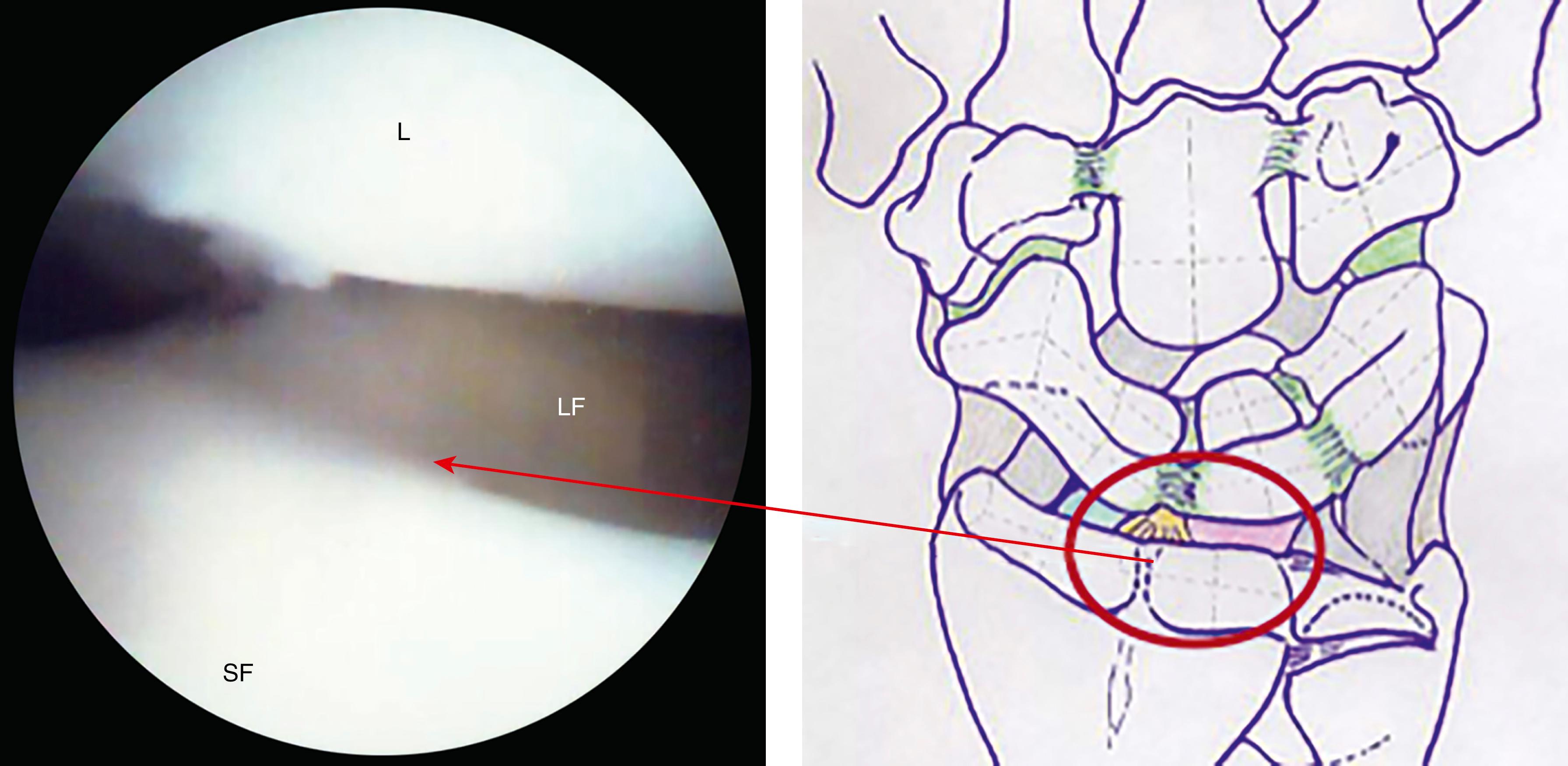 eFig. 17.17, Proximal surface of lunate and interfossa ridge of the distal radius separating the two fossi. L, Lunate; LF, lunate fossa; SF, scaphoid fossa.