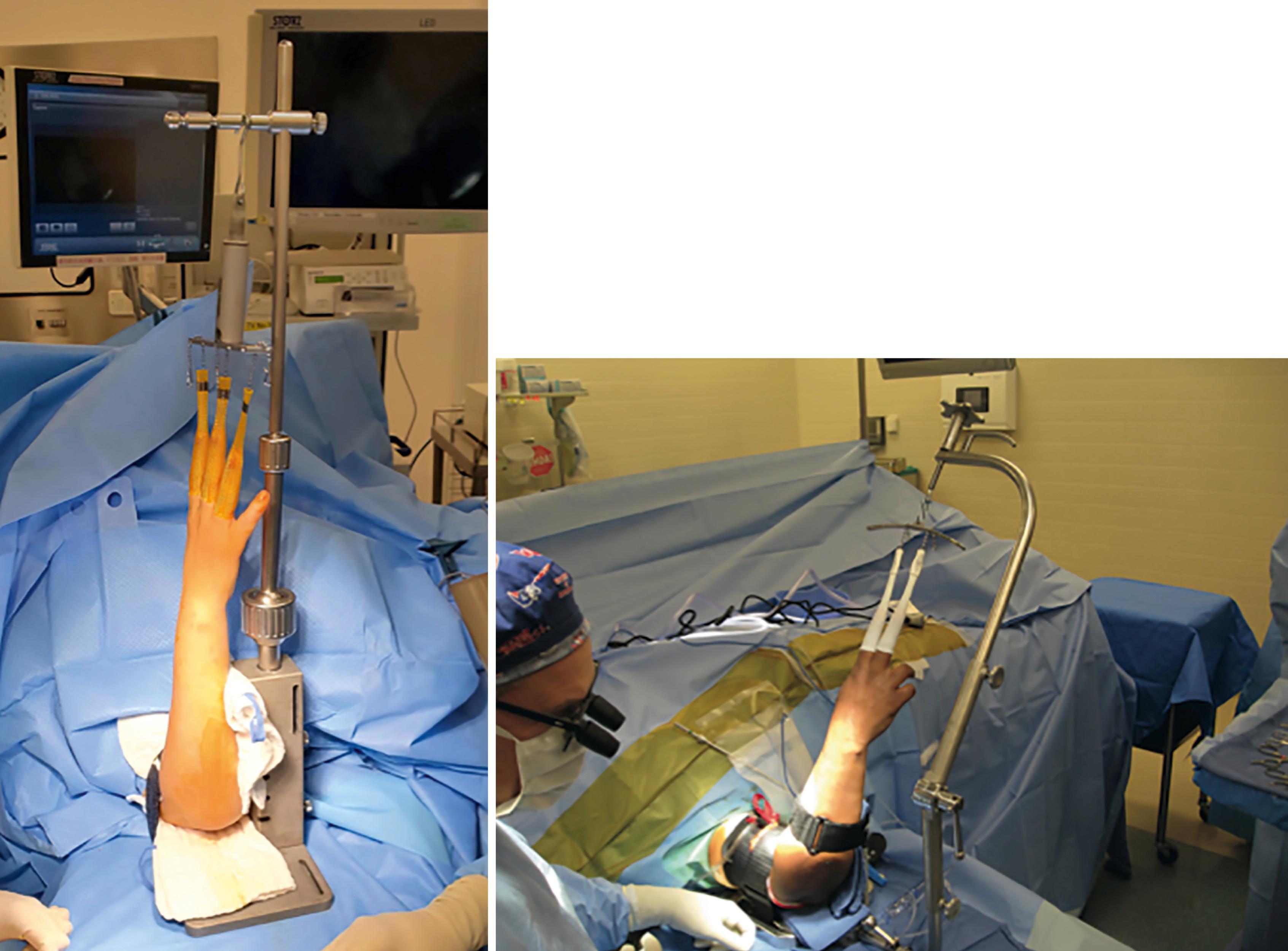 eFig. 17.1, Two types of sterilizable wrist traction tower with adjustable tension gauge and hinging device to adjust wrist positions. Two or three fingers are connected to the tower with plastic finger traps. Countertraction is applied to the arm at the base plate via nylon strap.