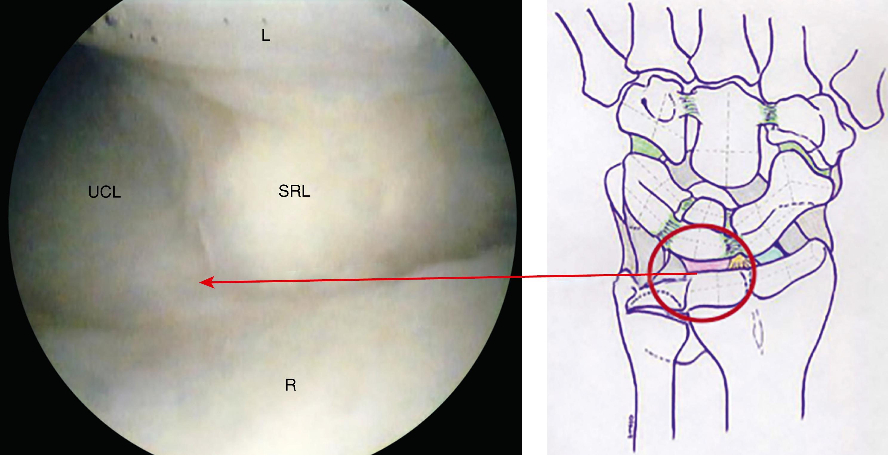 eFig. 17.19, Ulnolunate ligament portion of the ulnocarpal ligament complex. L, Lunate; R, radius; SRL, short radiolunate ligament; UCL, ulnocarpal ligament.
