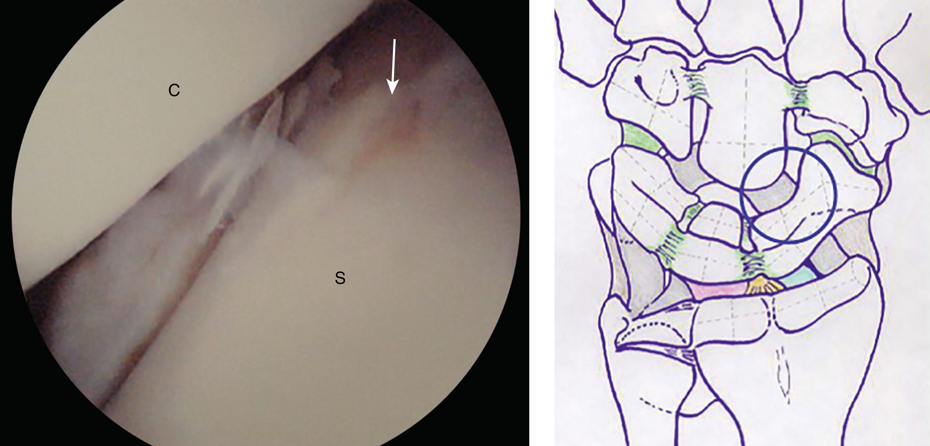 eFig. 17.21, Scaphocapitate joint as viewed from midcarpal radial (MCR) portal at midcarpal joint. C, Capitate; S, scaphoid.