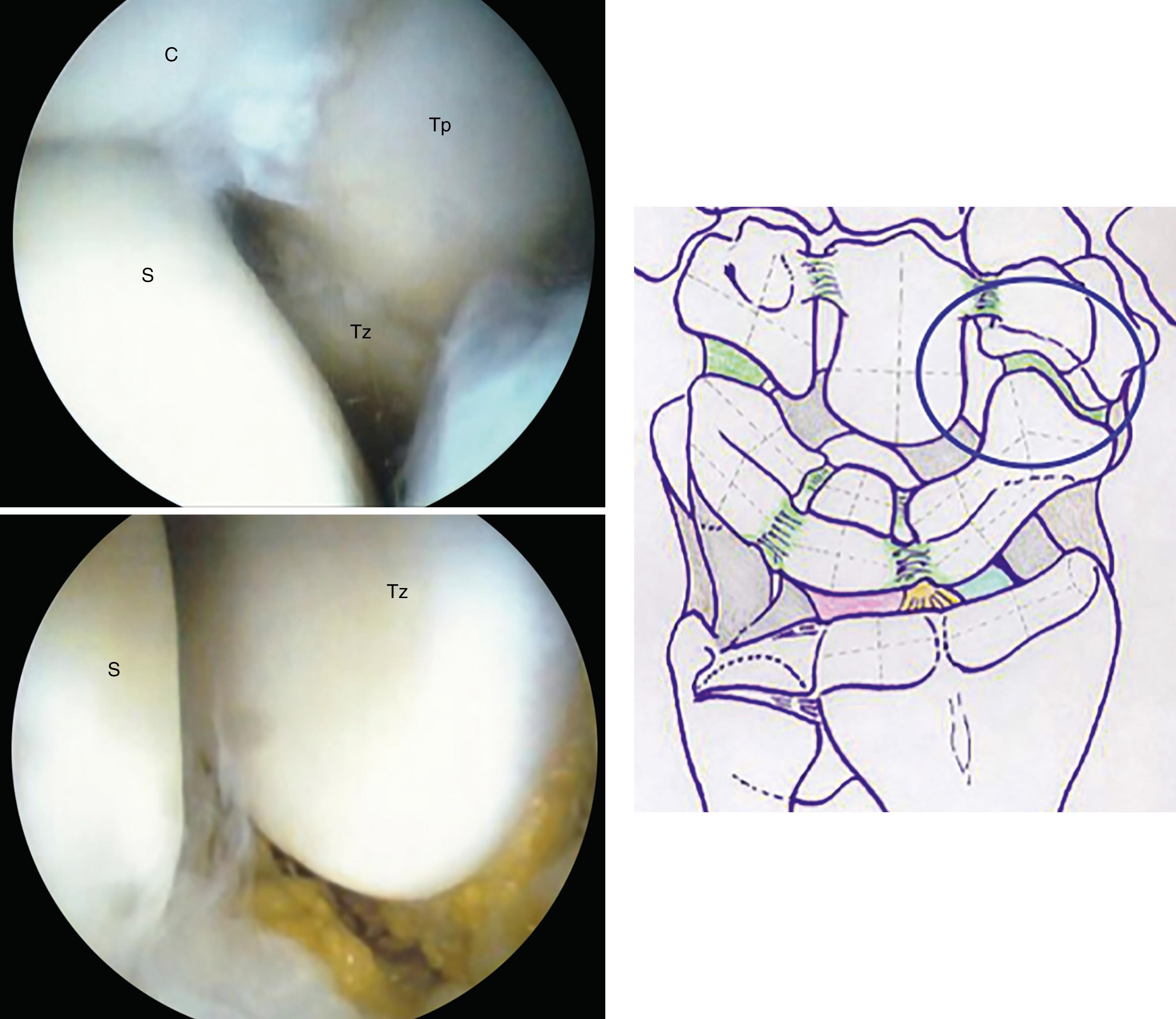 eFig. 17.22, Scaphotrapeziotrapezoid (STT) joint. C, Capitate; S, scaphoid; Tp, trapezoid; Tz, trapezium.