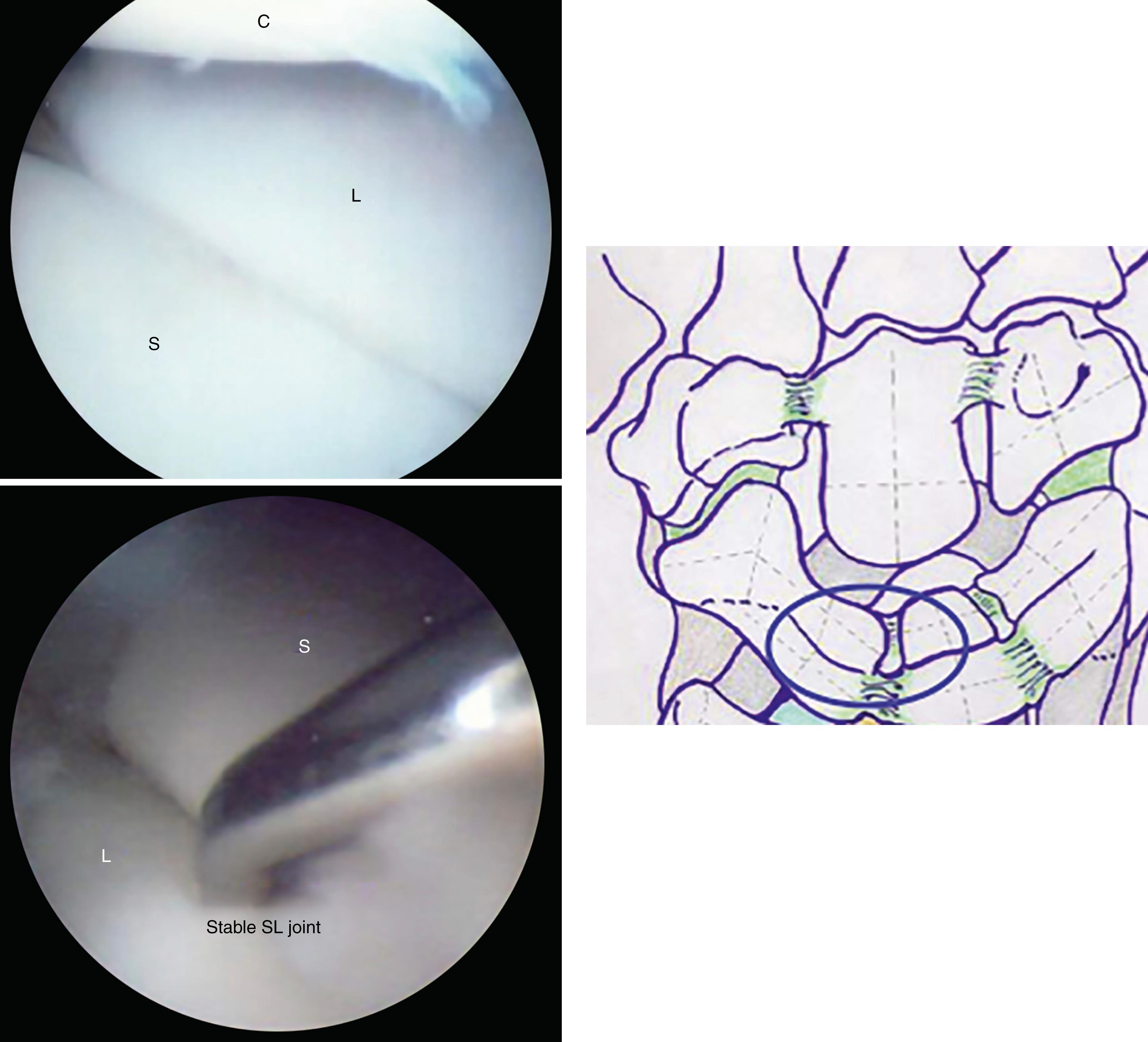 eFig. 17.23, Normal scapholunate (SL) joint which cannot admit a probe. C, Capitate; L, lunate; S, scaphoid.