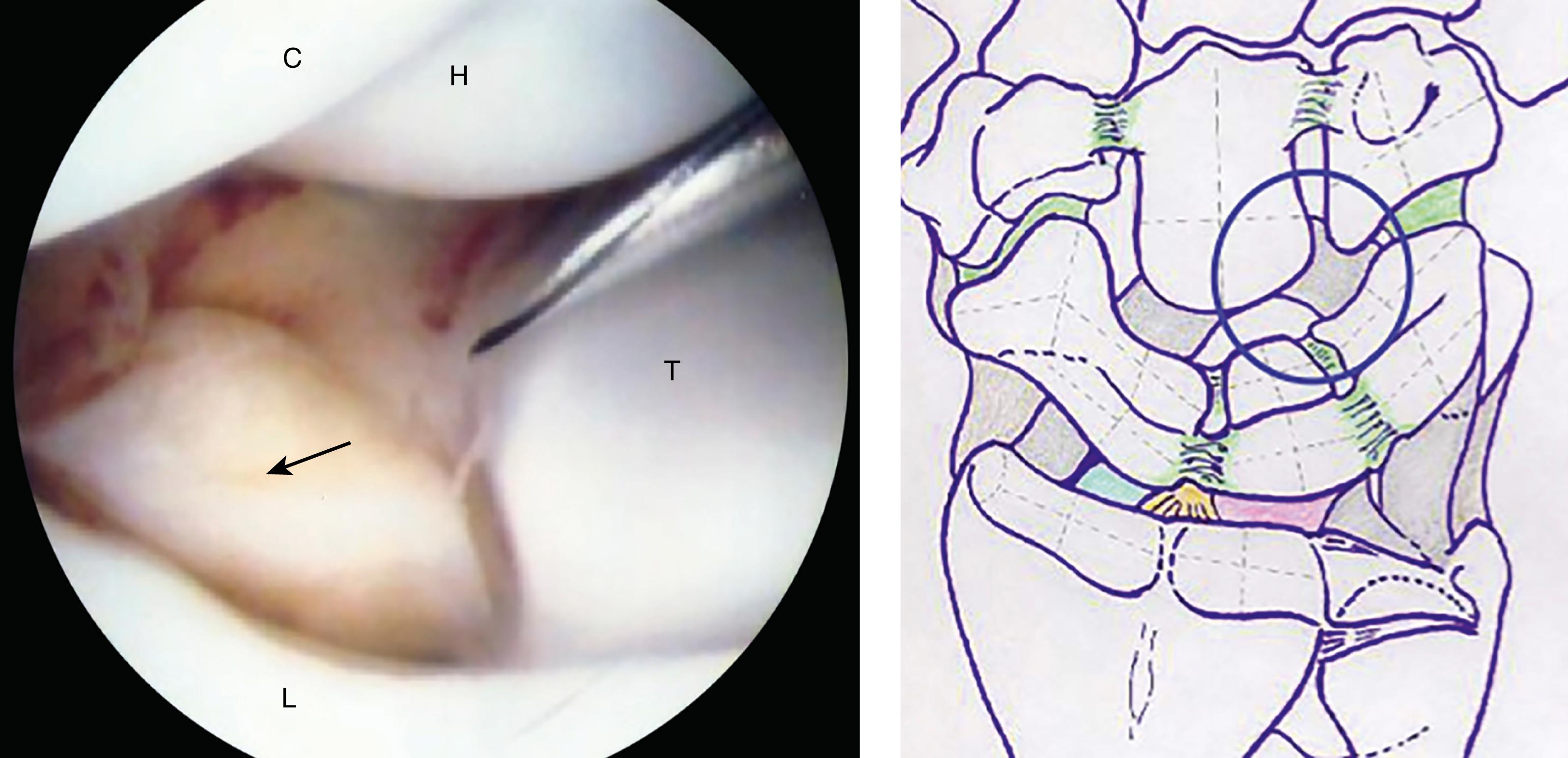 eFig. 17.24, The junction of capitate (C), hamate (H), lunate (L), and triquetrum (T) forms the so-called baby buttock. The arrow depicts a normal intraarticular thick synovial padding at the volar junction of the LT joint. It can be mistaken as a loose body or osteochondral fracture for the inexperienced.