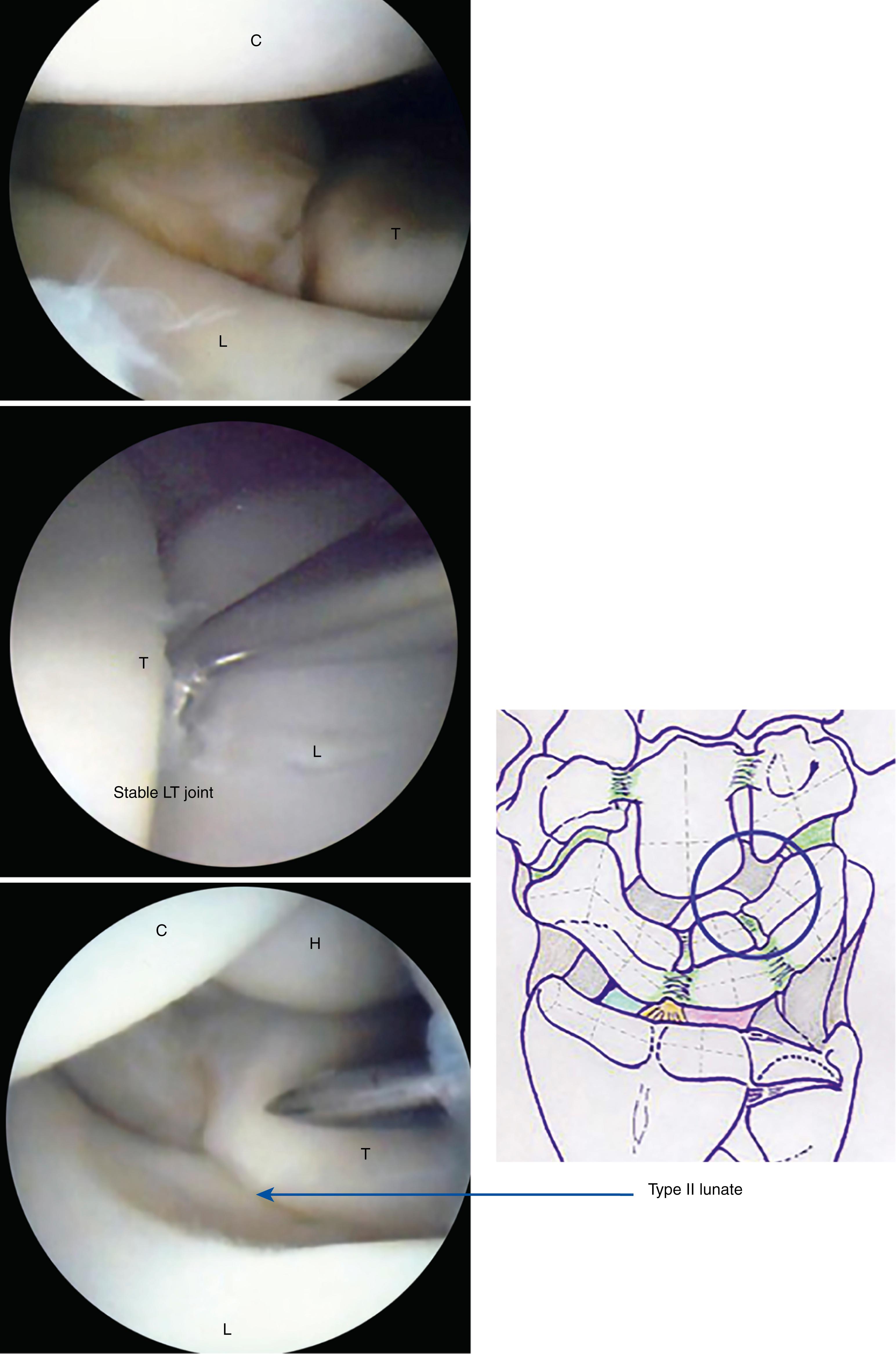 eFig. 17.25, Capitolunate joint and lunotriquetral joint. Note the second facet articulating with hamate in type II lunate. C, Capitate; H, hamate; L, lunate; T, triquetrum.