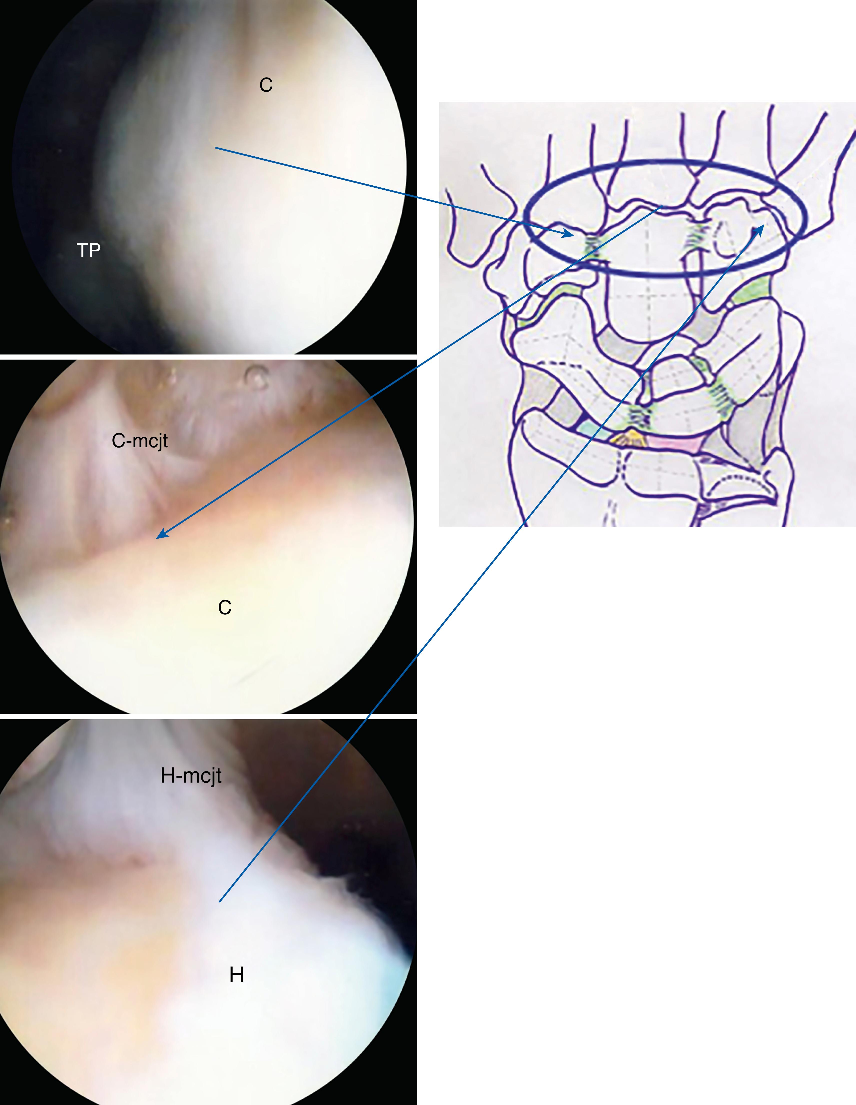 eFig. 17.27, Carpometacarpal joint capsule region. C, Capitate; C-mcjt, dorsal capsule of capitate; H, hamate; H-mcjt, dorsal capsule of hamate.