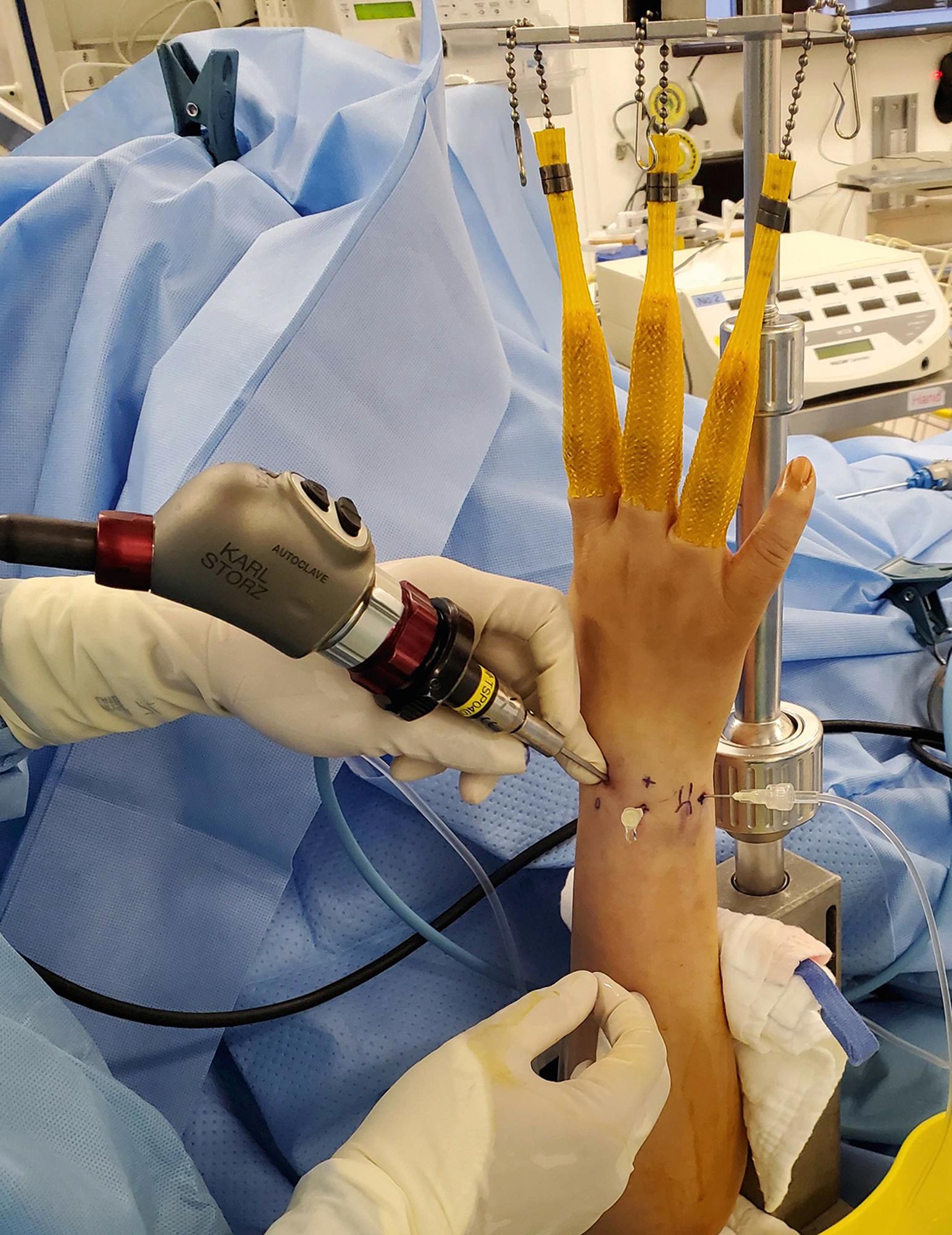 Fig. 17.4, Finger pivoting technique to control the fine movement of the arthroscope within the joint. When moving the arthroscope inside the joint, use screwing action rather than straight in and out action to avoid frequent dropping of the scope out of the shallow joint.