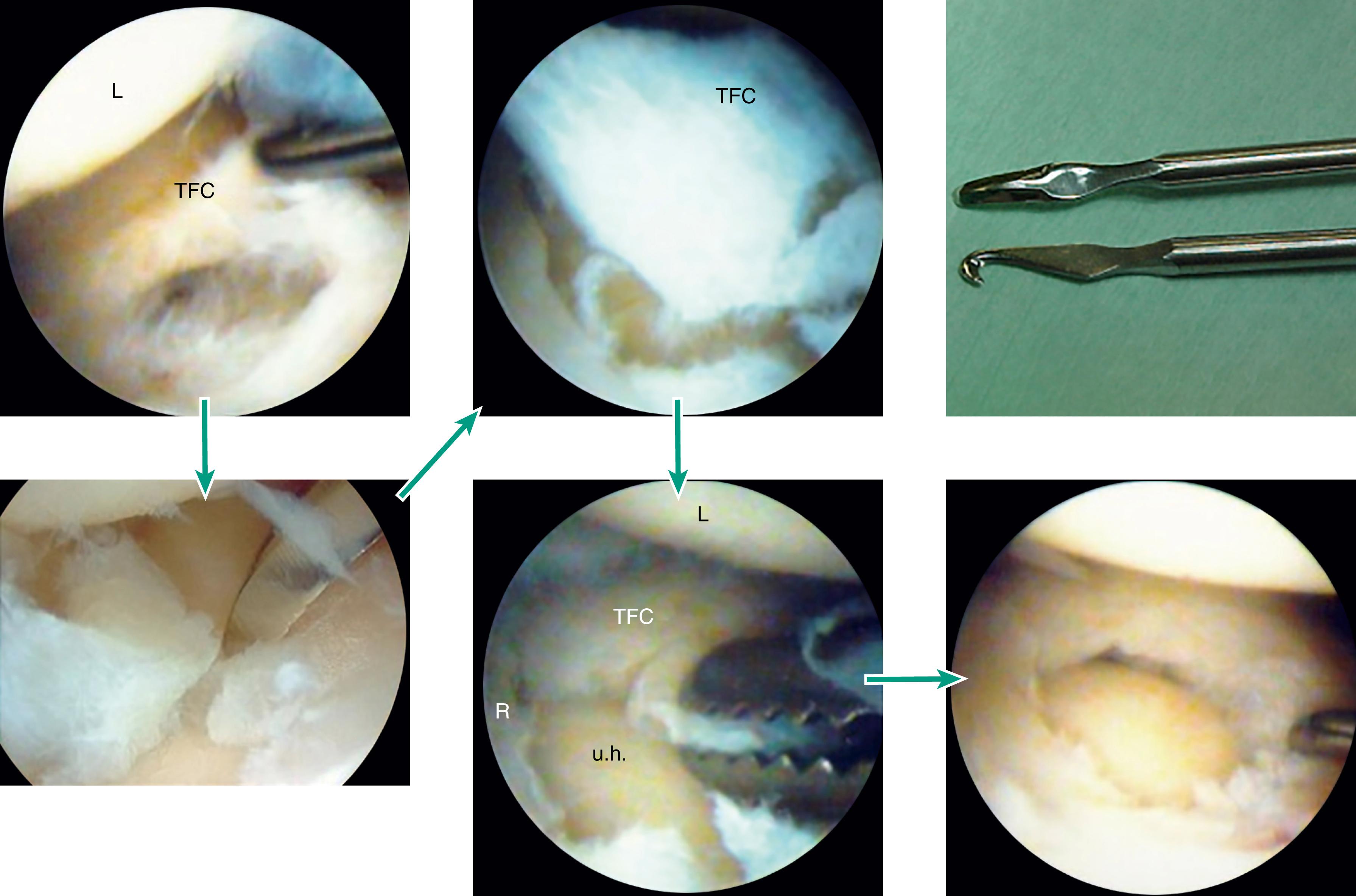 Fig. 17.5, Traumatic central tear of TFCC debrided with an arthroscopic knife and mosquito grasper until a smooth and stable peripheral rim is obtained.