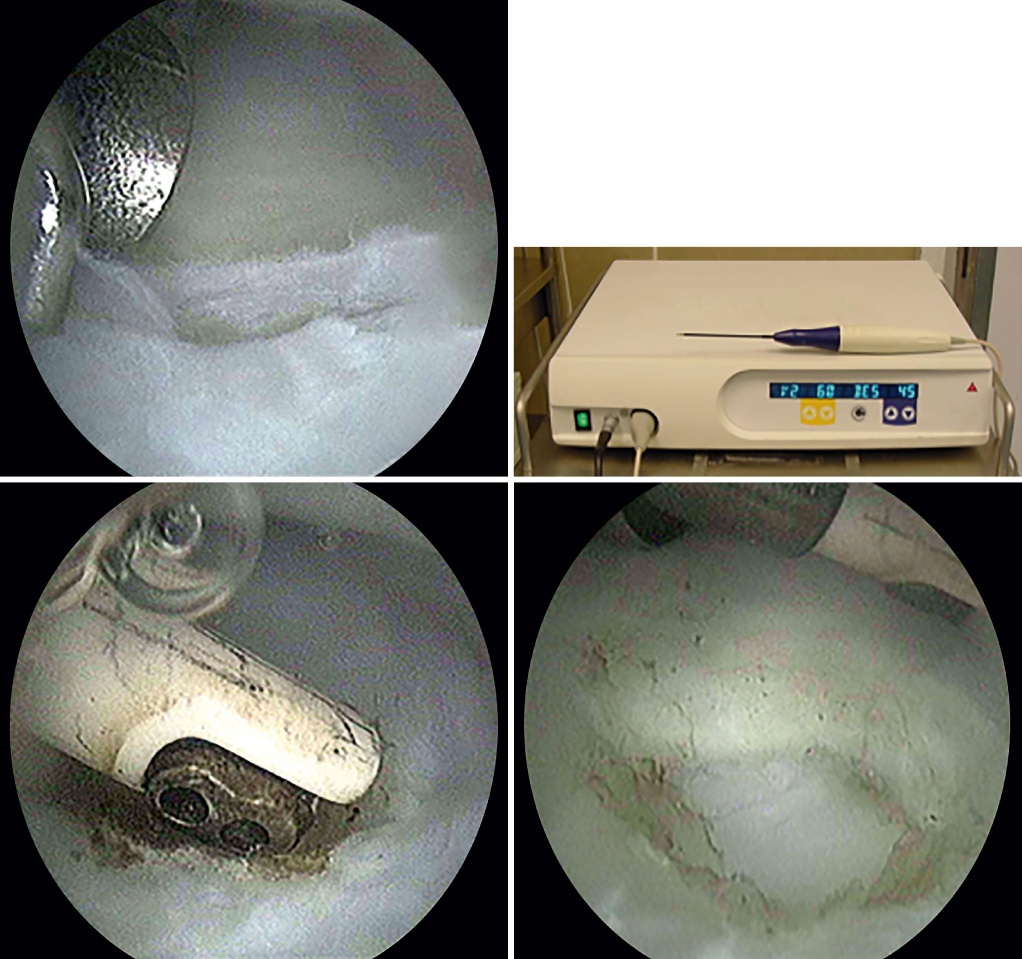 Fig. 17.6, Debridement of traumatic central tear of TFCC using a radiofrequency probe until a smooth and stable peripheral rim is obtained.