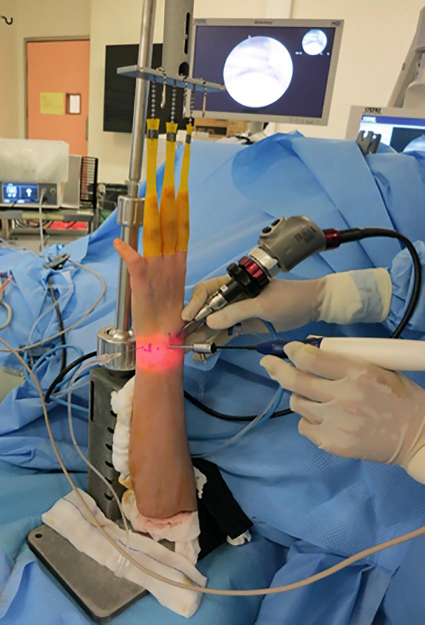 eFig. 17.29, The radiofrequency probe is introduced into the joint through an arthroscopic cannula that serves as a venting mechanism to release the air bubble being generated.