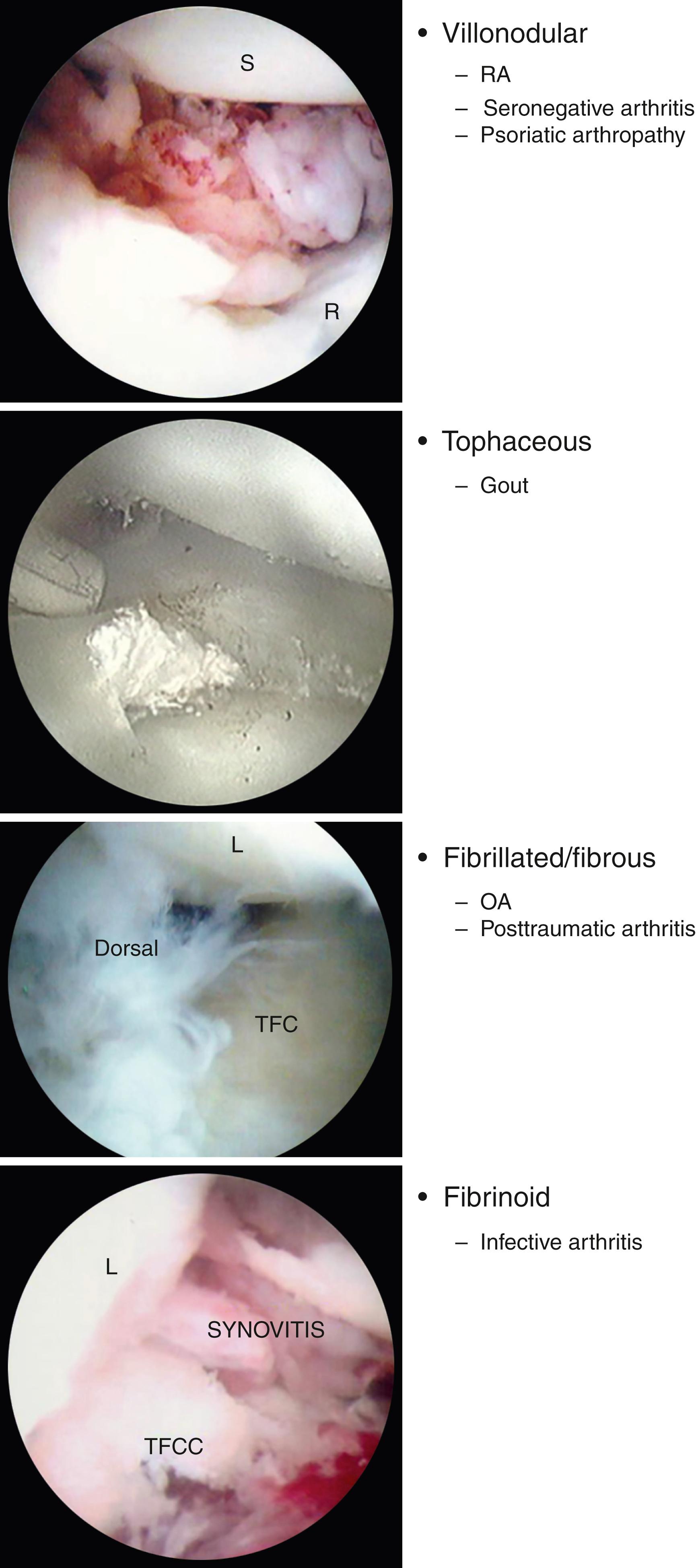 Fig. 17.7, Arthroscopic morphology of synovitis of different etiologies: villonodular, tophaceous, fibrillated or fibrous, fibrinoid. OA, Osteoarthritis; RA, rheumatoid arthritis.