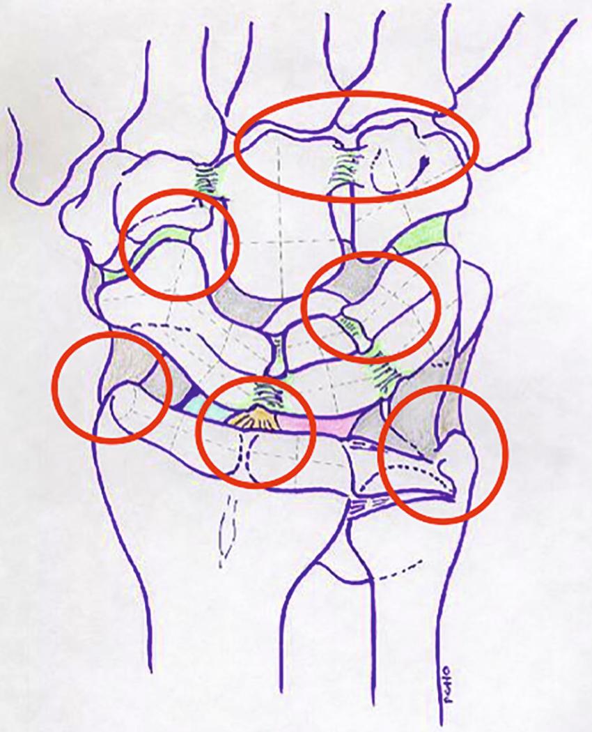 eFig. 17.30, The common sites of synovitis in the wrist in inflammatory arthritis that need to be addressed at arthroscopy.