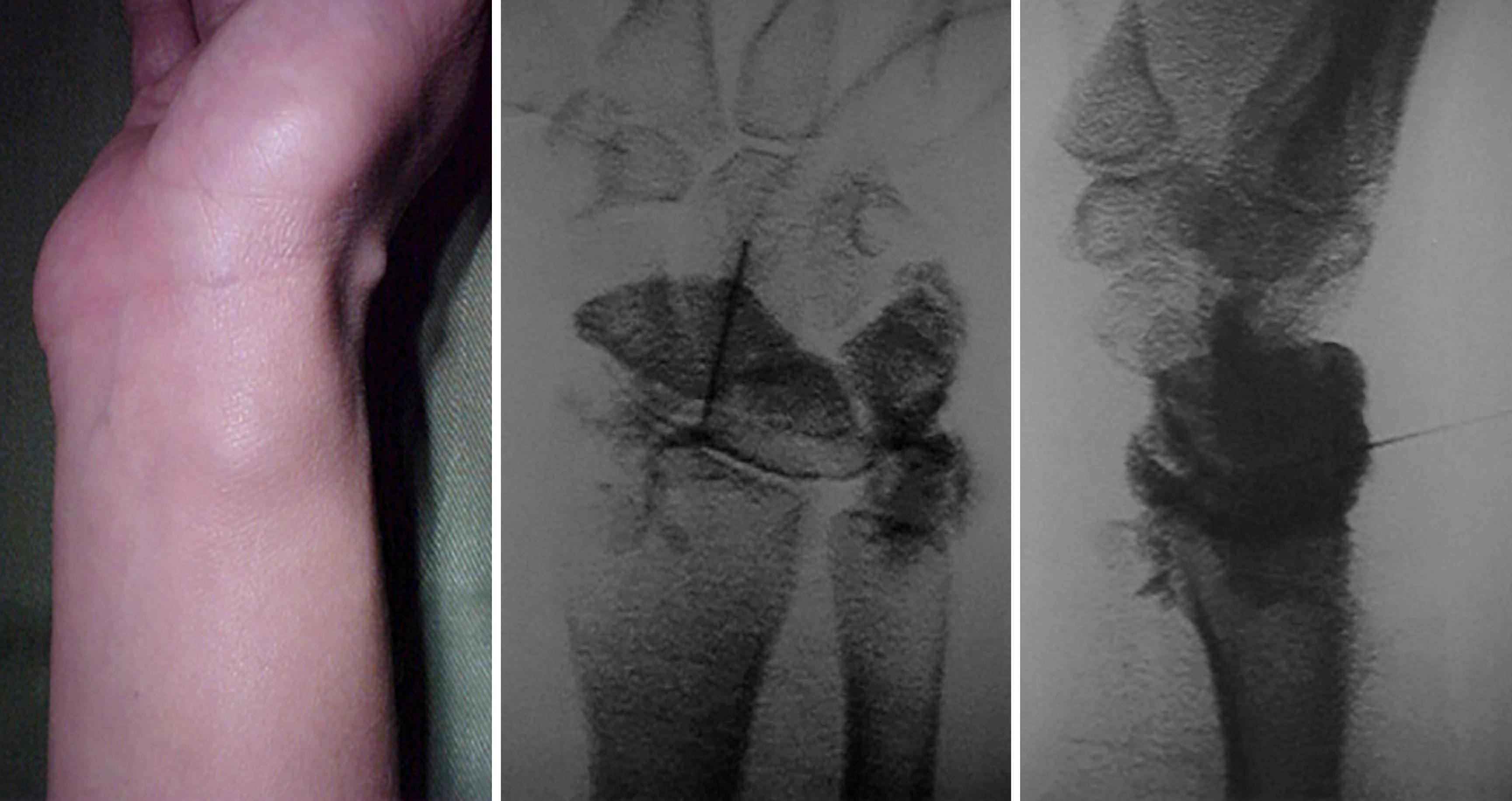 Fig. 17.13, Intraoperative wrist arthrogram to demonstrate the communication of the ganglion cyst with the wrist joint through the stalk.