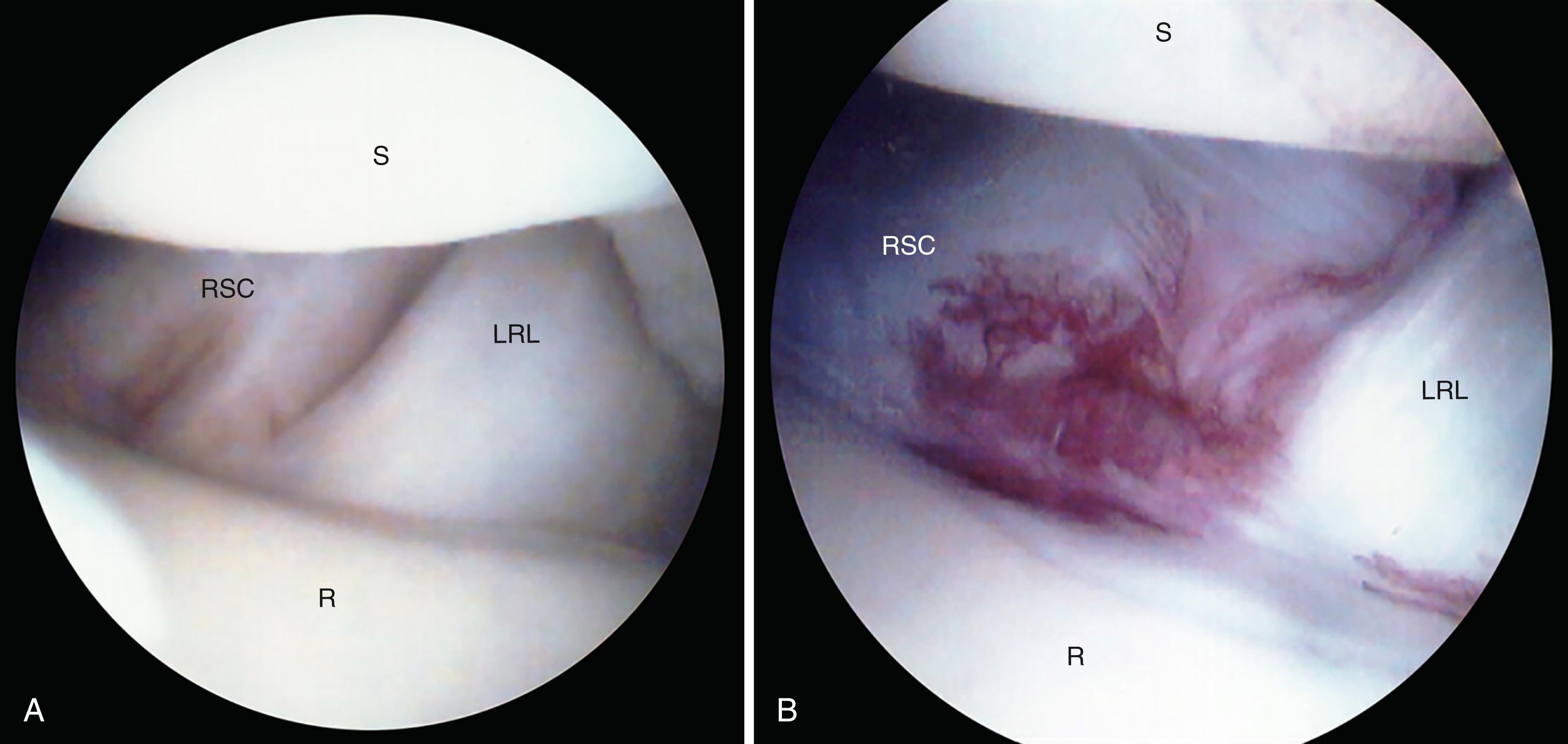 Fig. 17.14, Sign of stalk of volar ganglion from the radiocarpal joint. A, Normal interval between radioscaphocapitate ligament and long radiolunate ligament. B, Abnormal synovitis at the ligament interval in patient with volar wrist ganglion. LRL, Long radiolunate ligament; R, radius; RSC, radioscaphocapitate ligament; S, scaphoid.