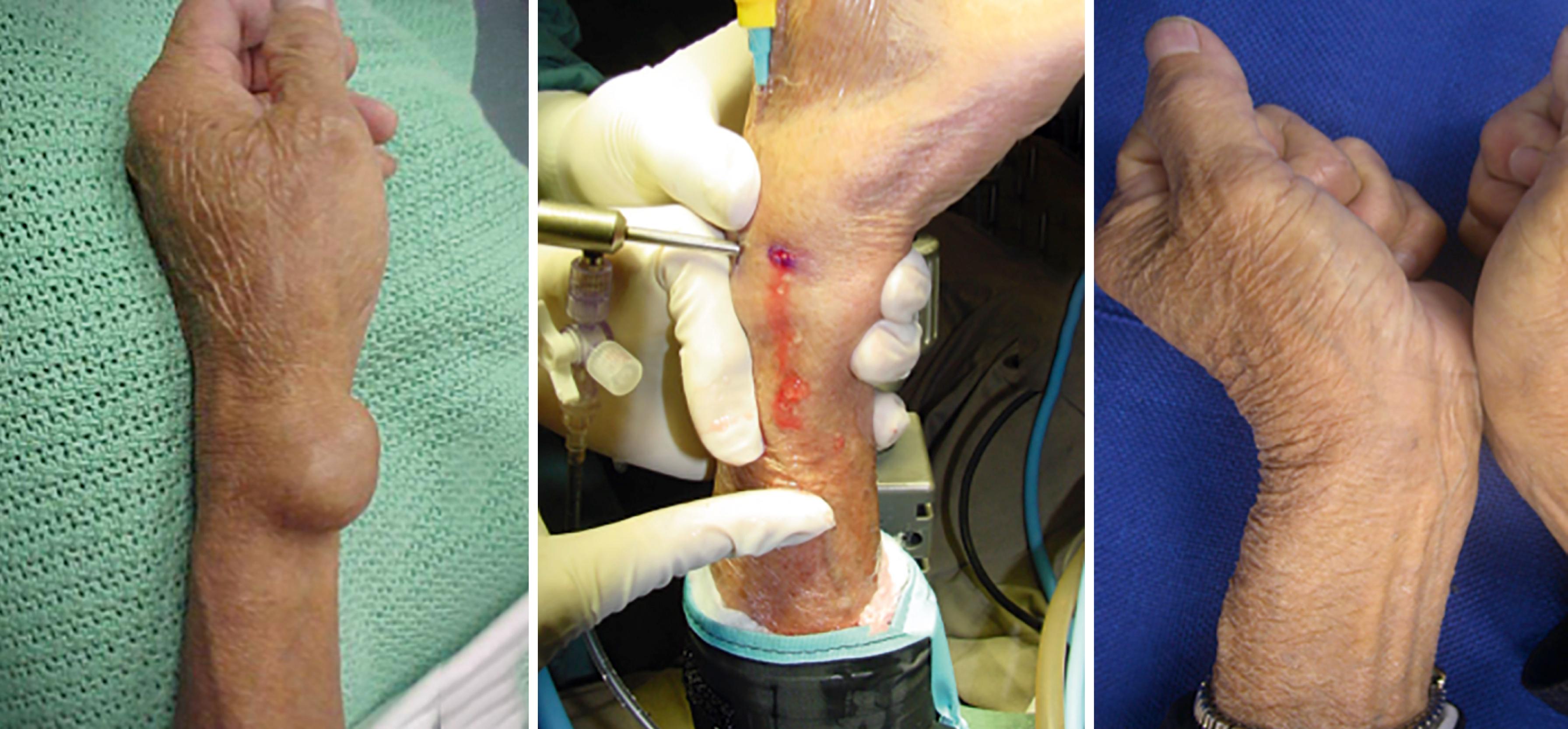 Fig. 17.17, A patient with a large recurrent volar ganglion treated with arthroscopic ganglionectomy. No recurrence was noted after 2 years of follow-up.