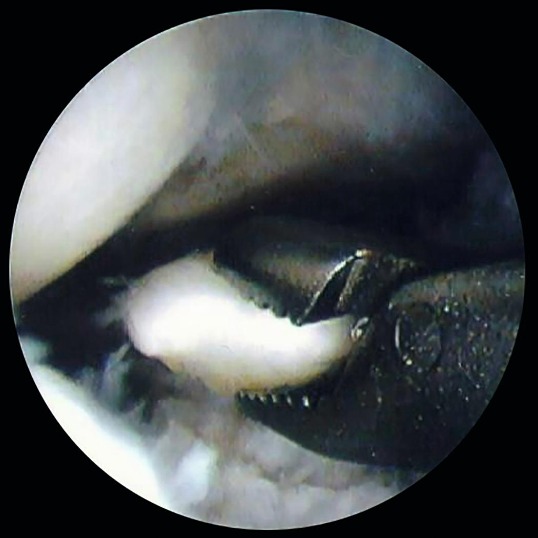 eFig. 17.31, Removal of a cartilaginous loose body at the radiocarpal joint using a mosquito grasper.