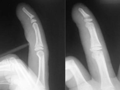 Fig. 135.2, Lateral and oblique radiographs demonstrating an open fracture through the physis of the distal phalanx, or Seymour fracture, in the typical posture of flexion.