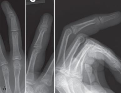 Fig. 135.3, Radiographs of a 12-year-old patient's finger (A) demonstrating a middle phalangeal neck fracture in ulnar deviation, extension, and malrotation. The degree of malrotation is such that the lateral view of the digit shows both the condyles, as it is an anteroposterior (AP) of the fracture fragment. AP and lateral after closed reduction and pinning (B) show restoration of anatomic alignment and stabilization with a buried intrafocal pin. Note the lateral demonstrating overlap of the condyles of both the proximal and middle phalanges, confirming correction of malrotation, as this is difficult to assess clinically once an interphalangeal joint is pinned in extension.
