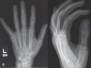 Fig. 135.4, Anteroposterior and lateral radiographs in a 16-year-old show a small finger proximal phalangeal base Salter Harris II fracture in the typical position of extension and ulnar deviation (A). Closed reduction under digital nerve block was followed by buddy strapping and post reduction radiographs (B) showing improved alignment.