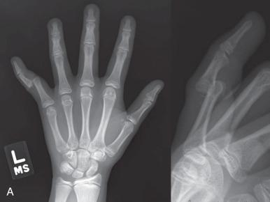 Fig. 135.6, Posterolateral dislocation of the small finger proximal interphalangeal joint is seen on anteroposterior and lateral radiographs (A). A close-up of the postreduction lateral radiograph (B) demonstrates a minimally displaced Salter Harris II fracture of the volar middle phalanx base (arrow) , which represents a stable avulsion fracture of the volar plate.