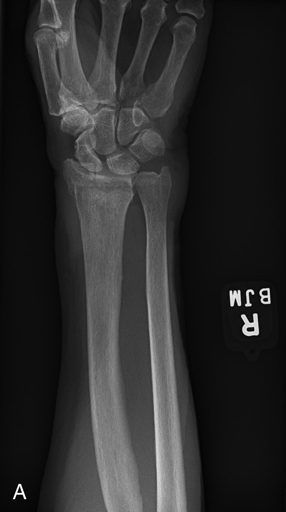 FIGURE 1, (A) Anterior-posterior, (B) oblique, and (C) lateral views of the right wrist of an 85-year-old woman involved in a ground-level fall. Imaging demonstrates a distal radius fracture with intra-articular extension. The fracture is noted to be angulated dorsally on the lateral image.