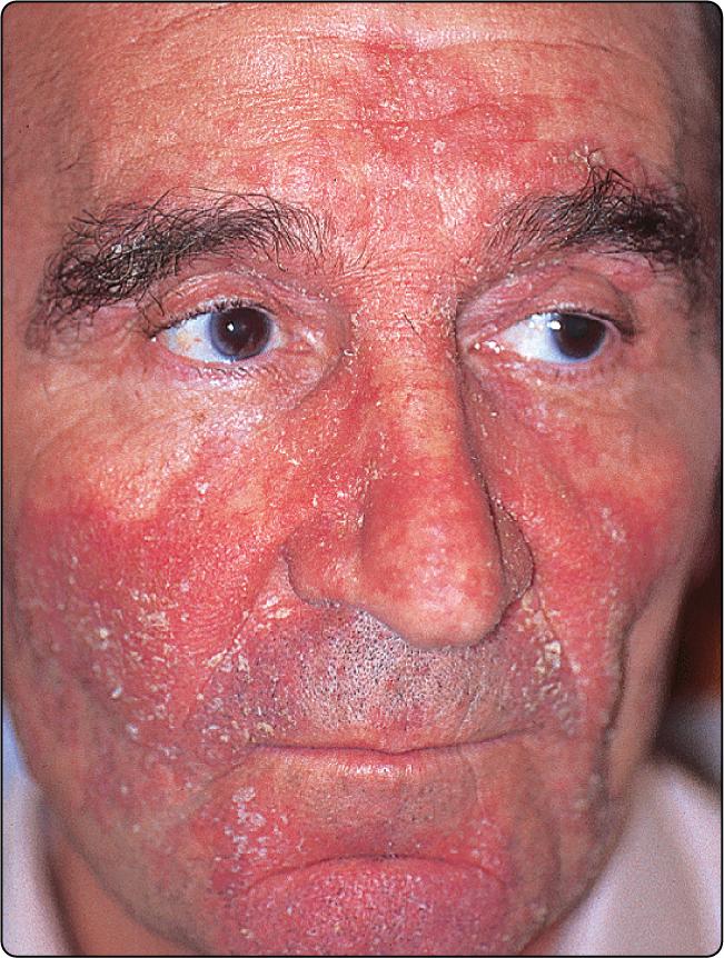 Fig. 33.1, Seborrhoeic dermatitis affecting the face.