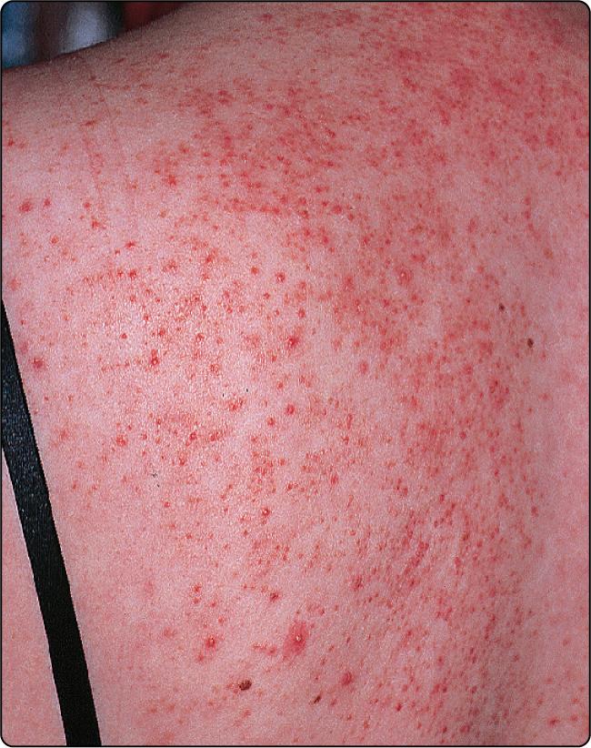 Fig. 33.2, Seborrhoeic dermatitis of the Pityrosporum folliculitis type affecting the back.