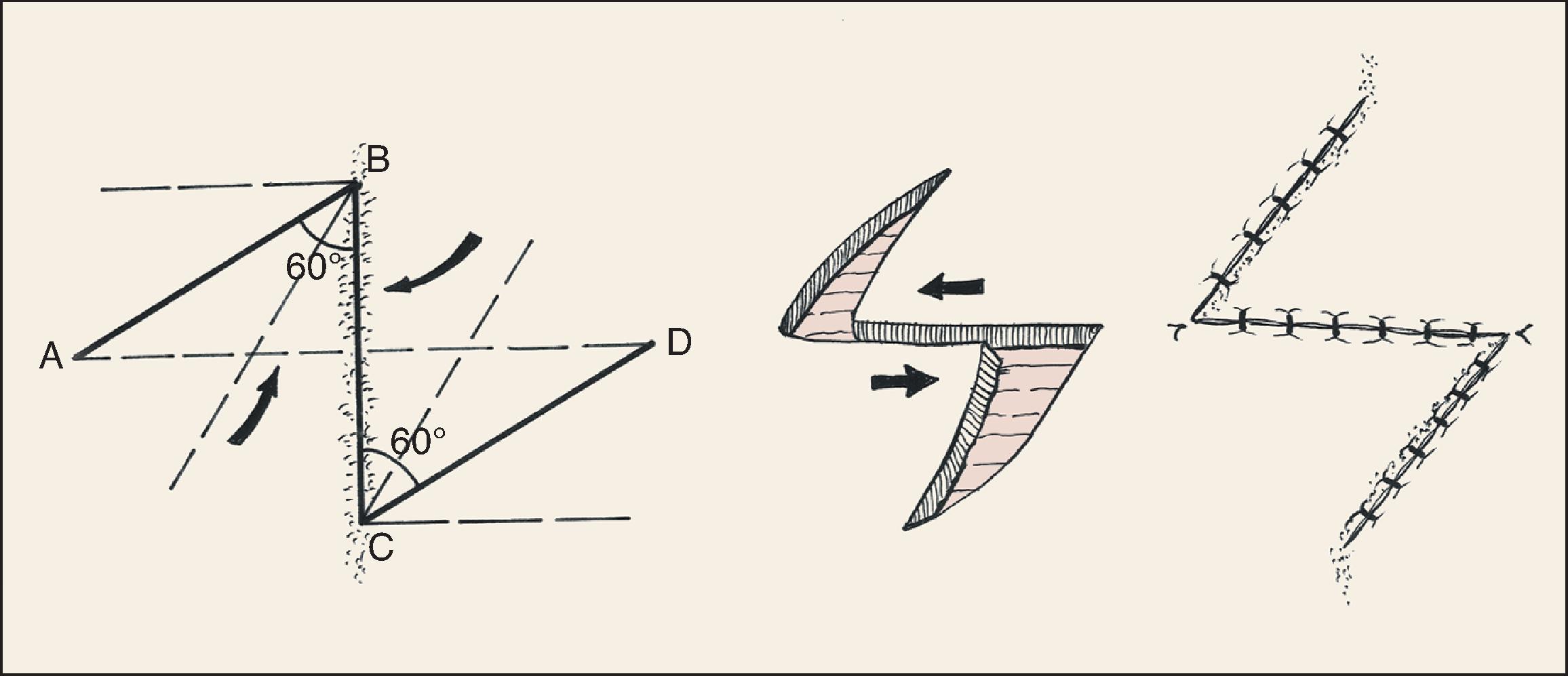 Fig. 14.1, Design of 60° Z-plasty.