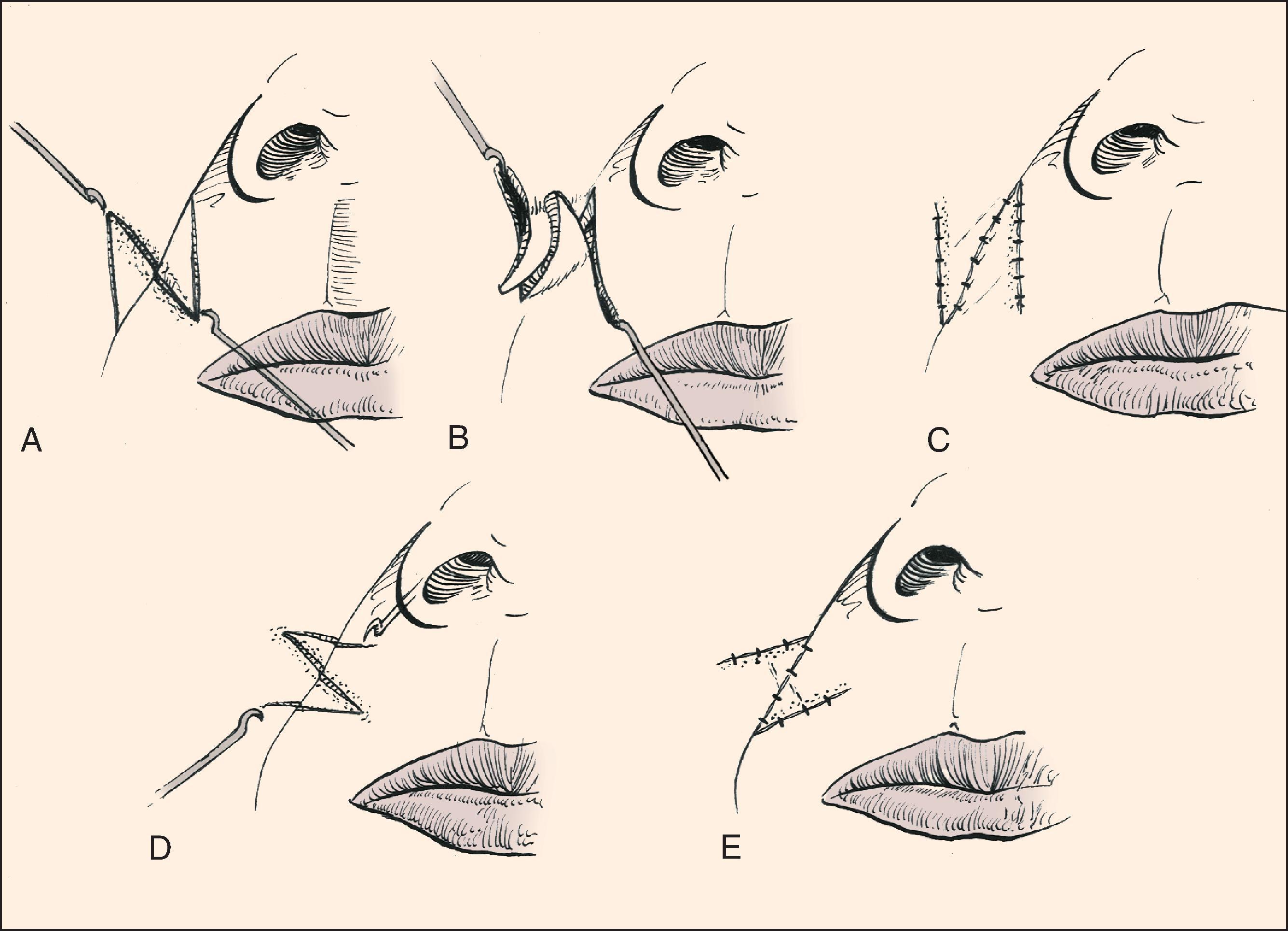 FIG. 14.11, Two alternatives for design of Z-plasty to correct scar perpendicular to melolabial crease ( A–C and D–E ). The first alternative is preferred.