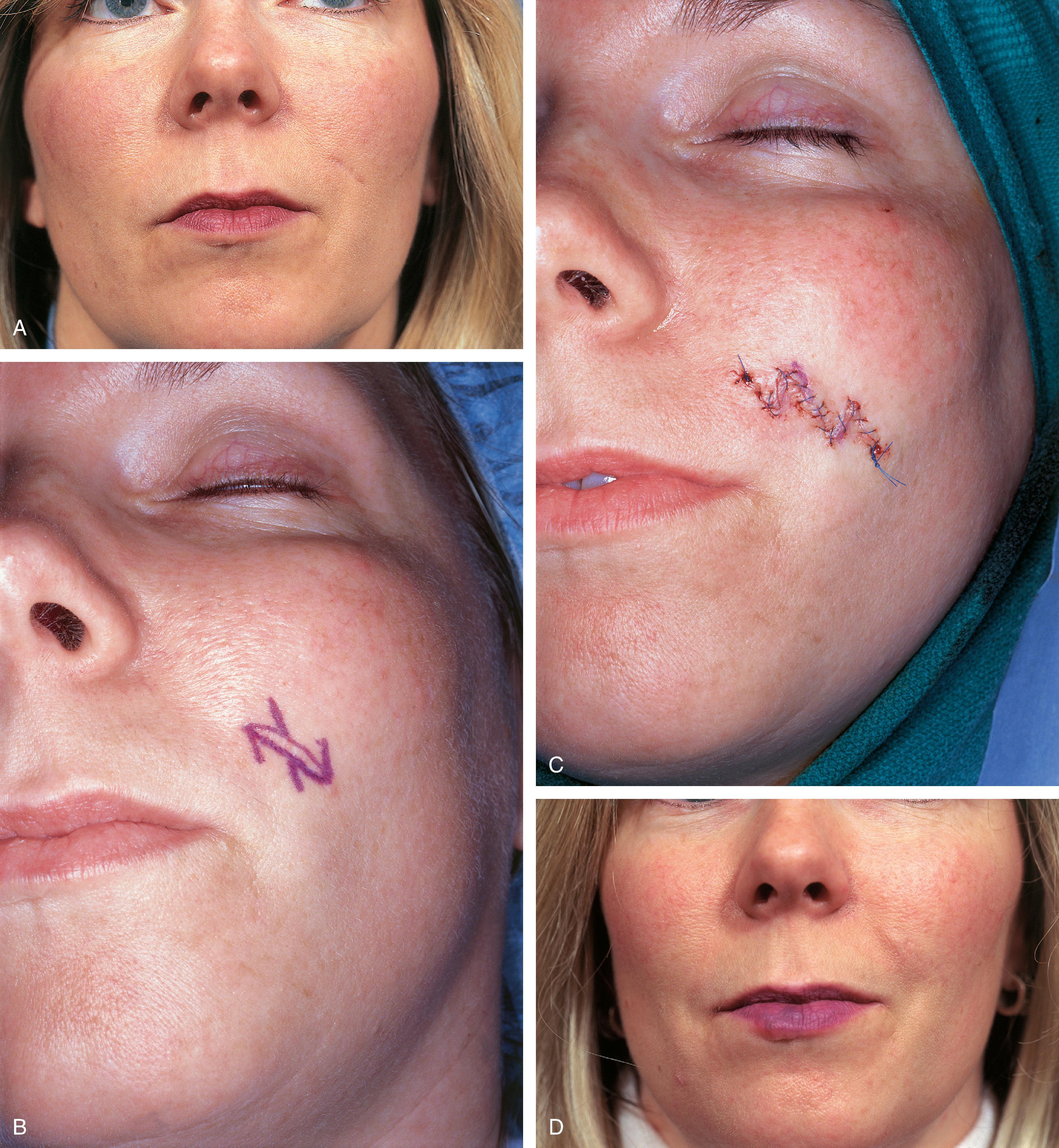 FIG. 14.12, A , Scar with unfavorable orientation. B , Two Z-plasties designed to align scar with melolabial crease. C , Flaps transposed and wound repaired. D , Postoperative view at 6 months. (Courtesy Shan R. Baker, MD.)